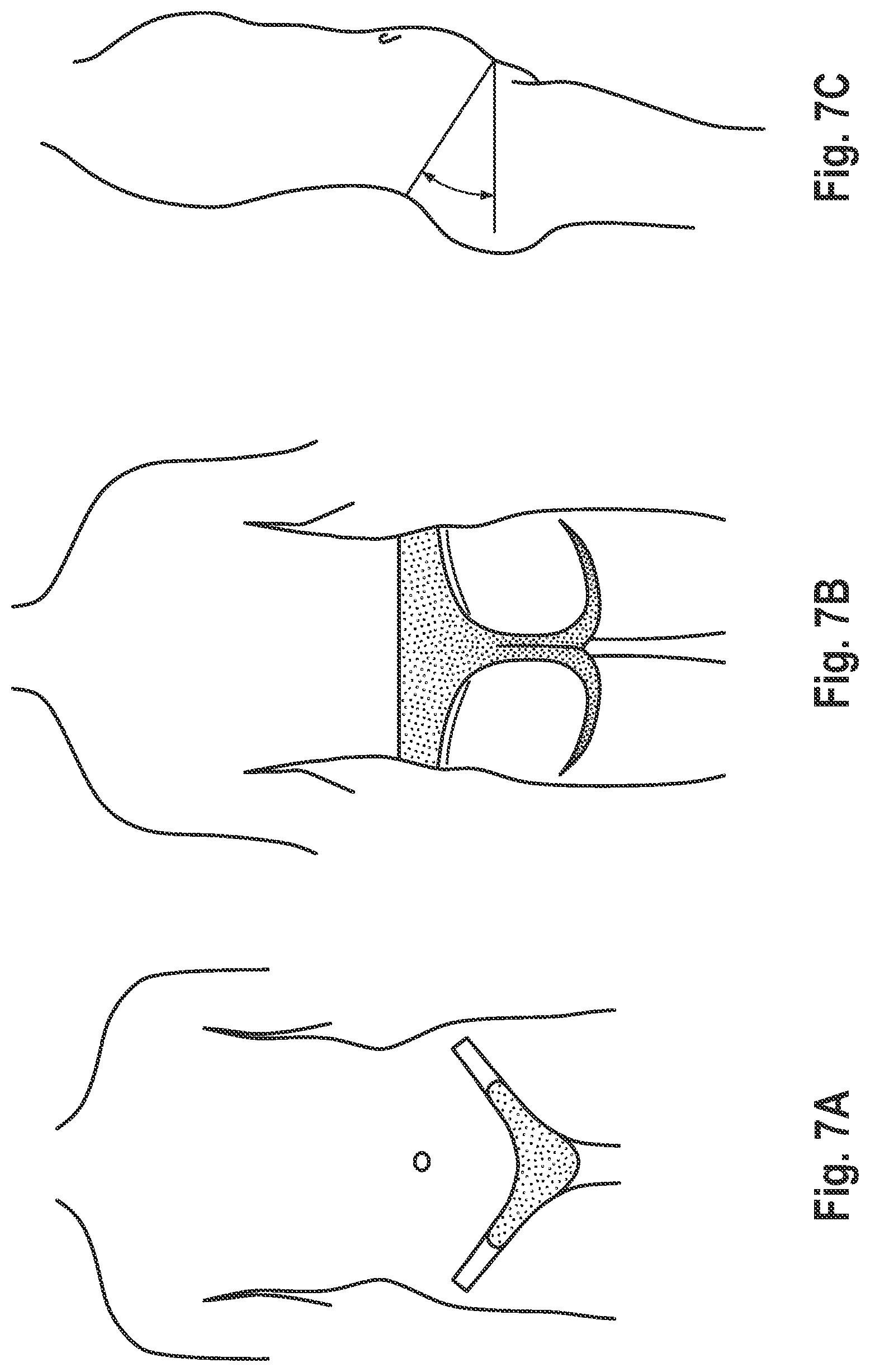 Patent US11793686 Figure 7 – Absorbent article with belt having profiled elasticity