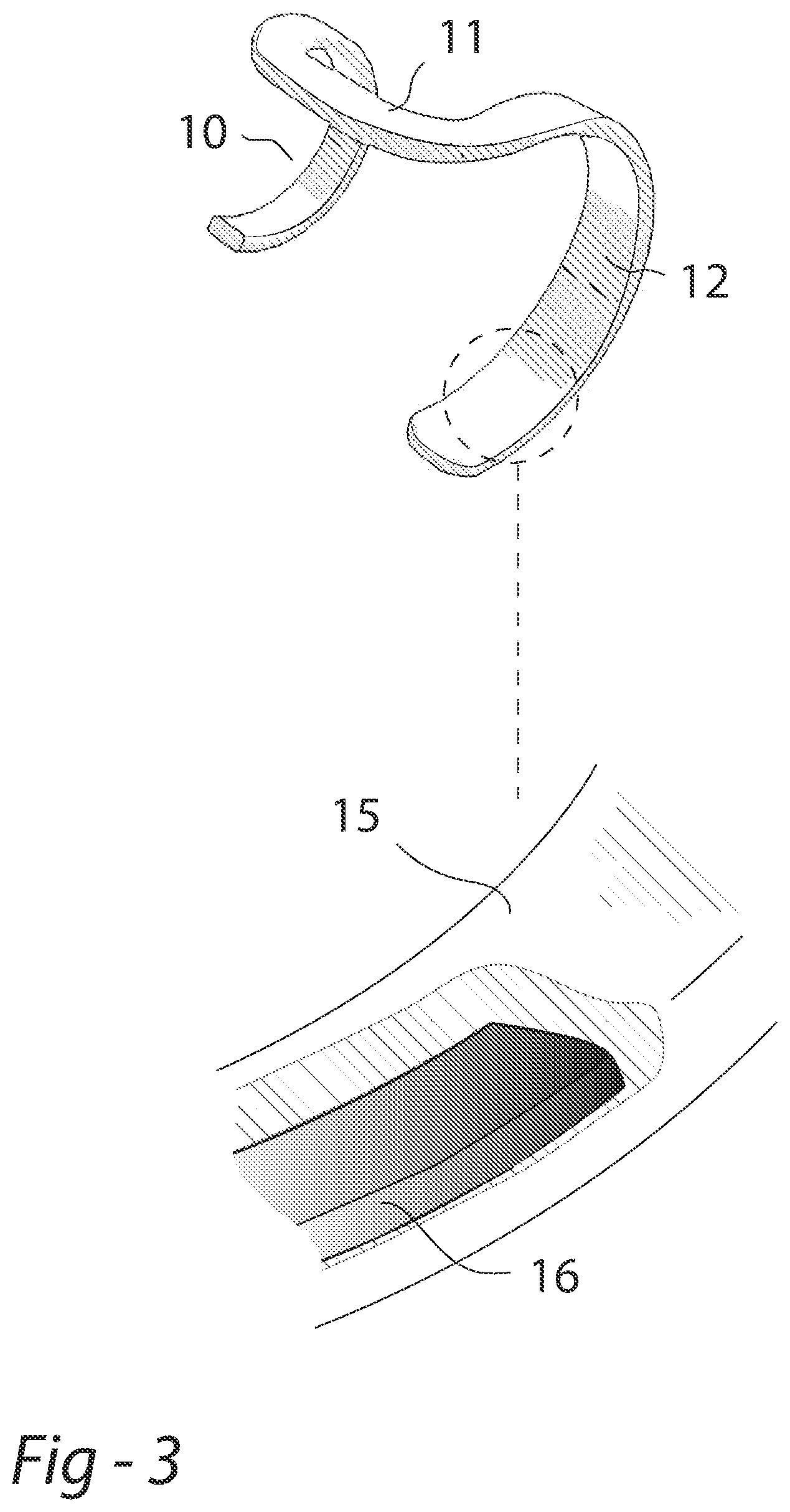 Patent US11793687 Figure 2 – Removable rubber bracelet for cast cutting