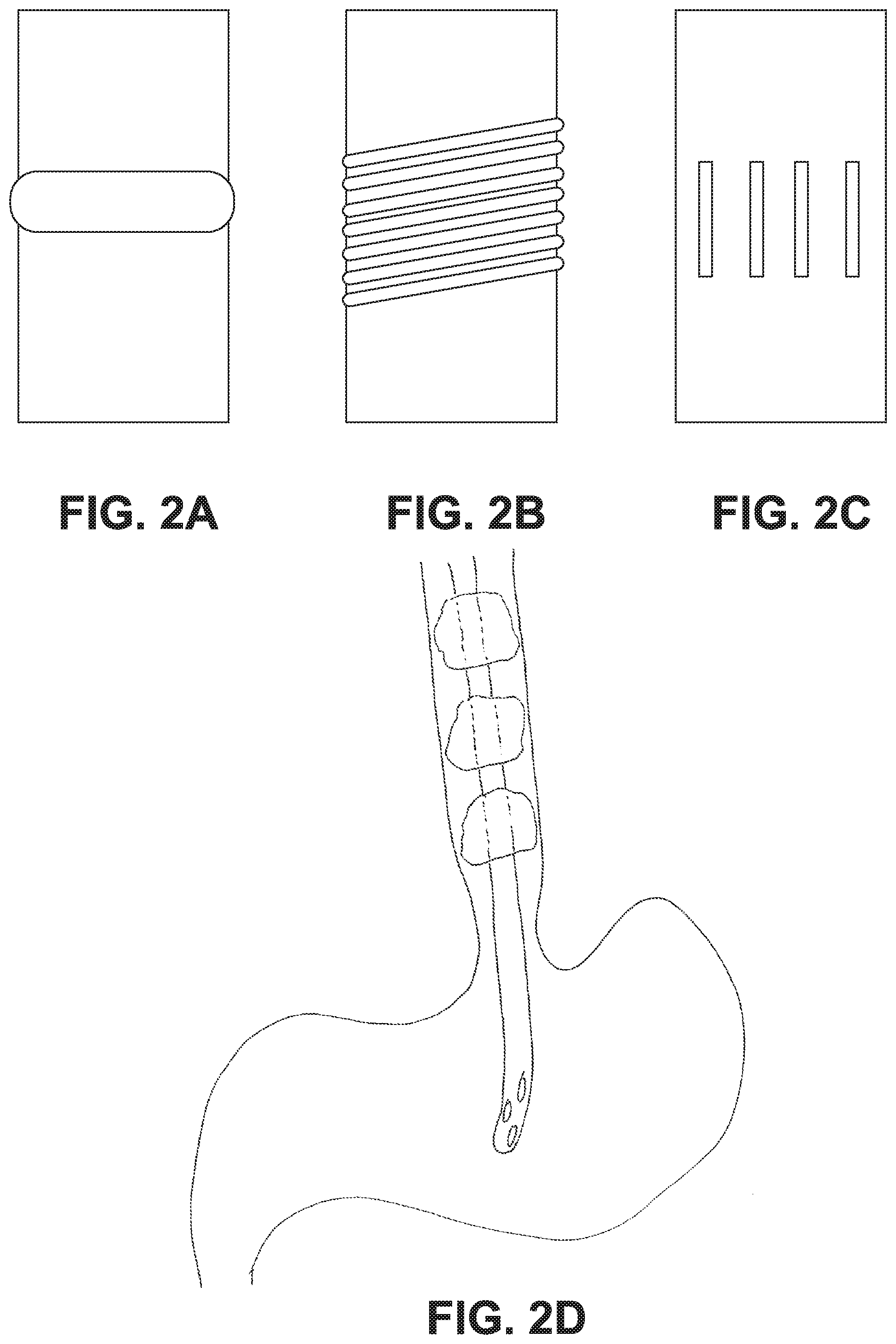 Patent US11793728 Figure 2 – Method and device of detecting and/or blocking reflux