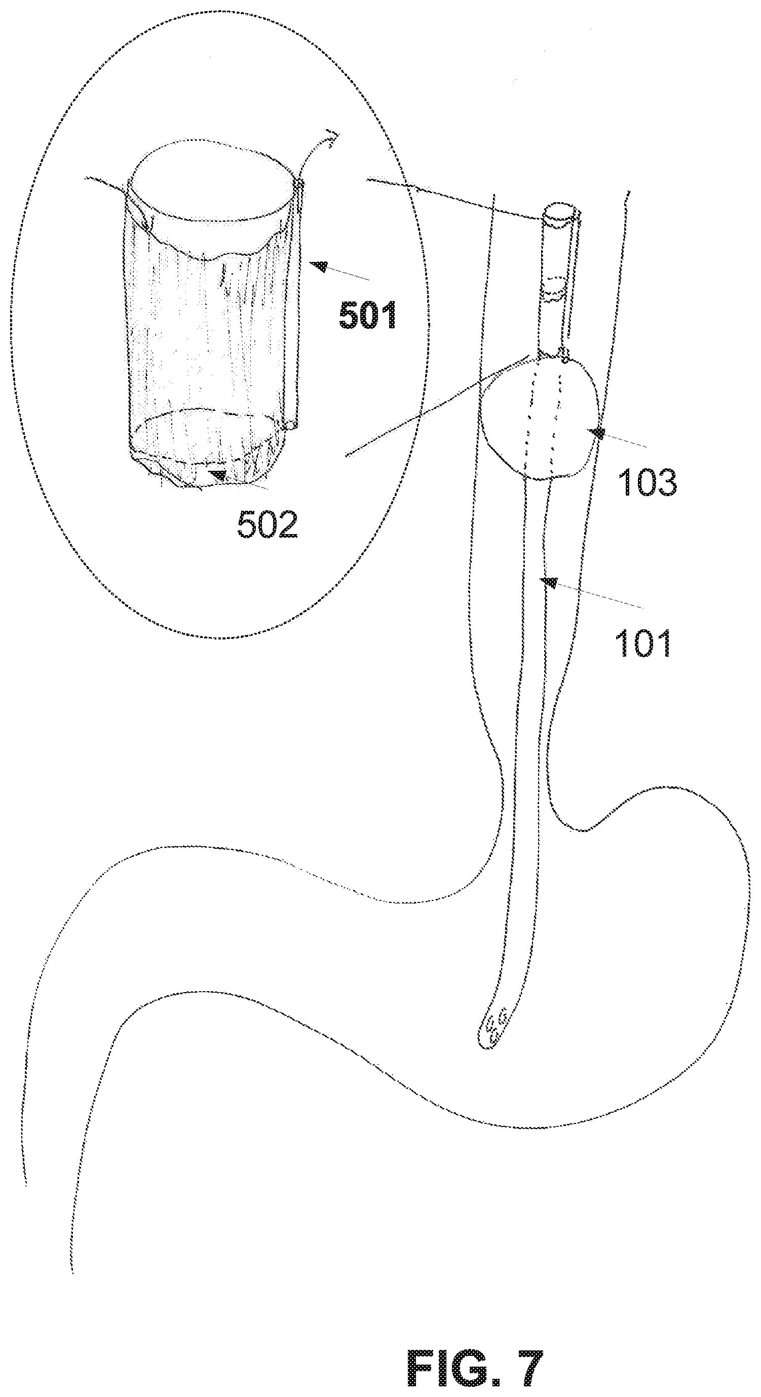 Patent US11793728 Figure 7 – Method and device of detecting and/or blocking reflux