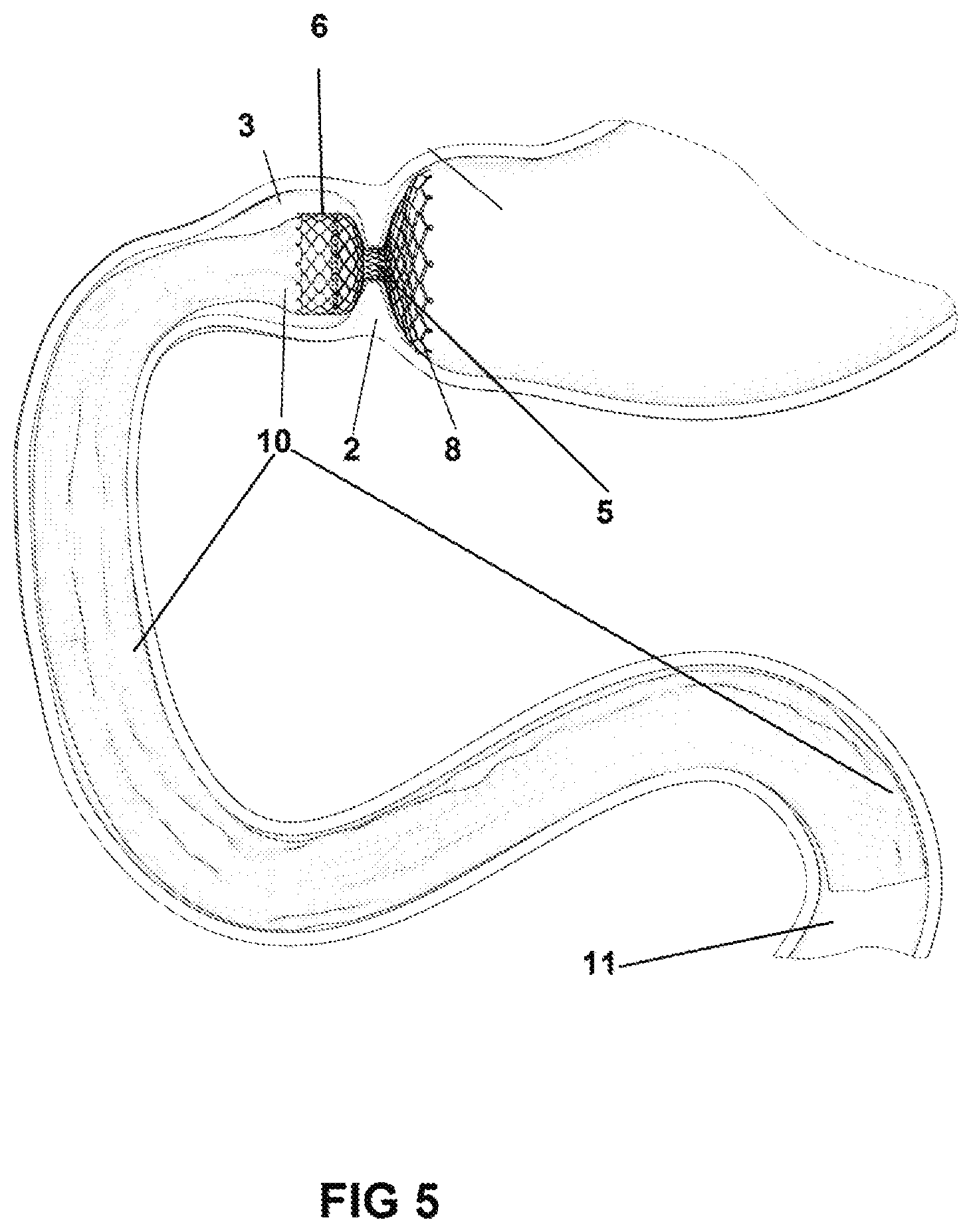 Patent US11793839 Figure 5 – System and method for affecting intestinal microbial flora