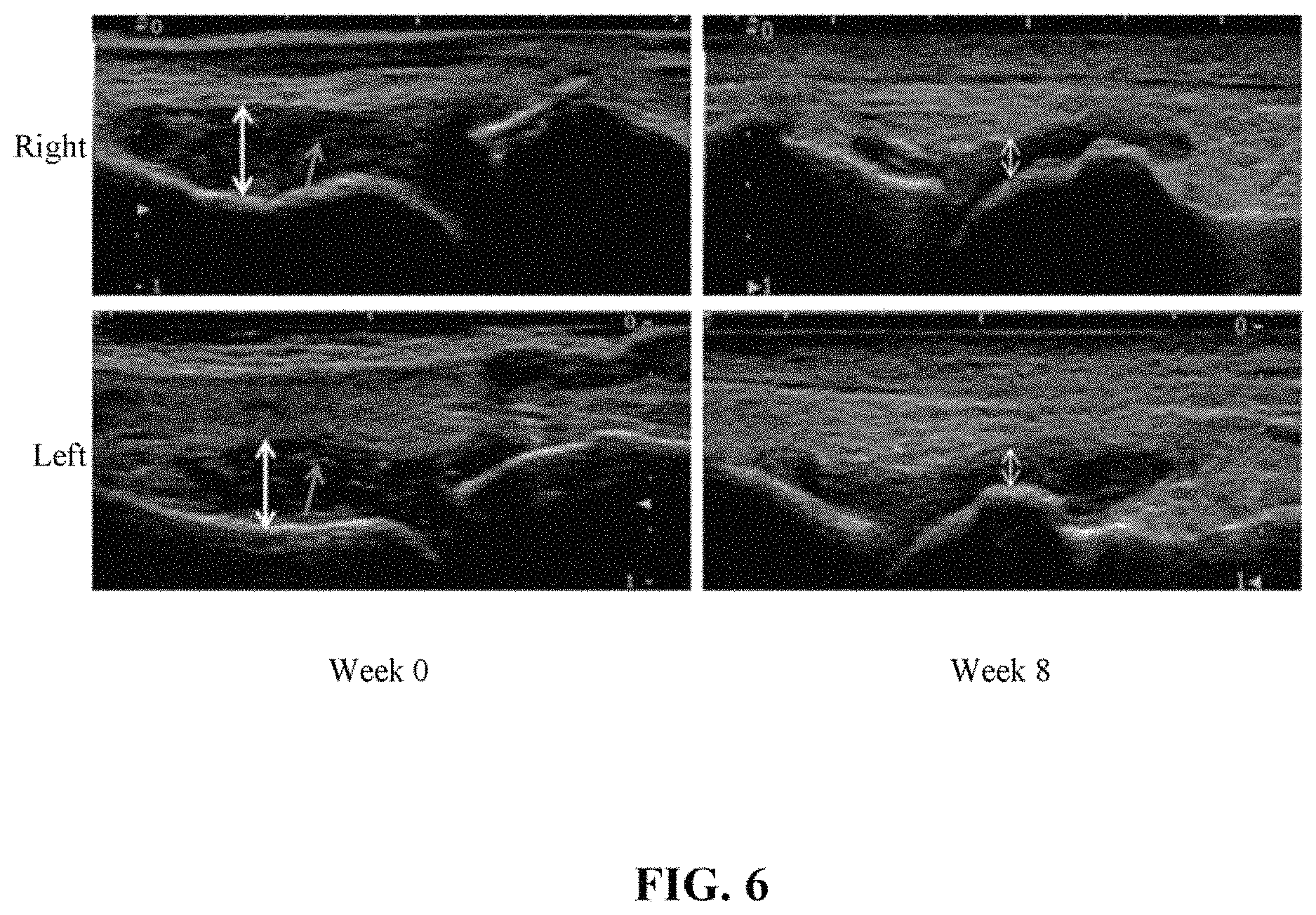 Patent US11793842 Figure 6 – Method for reducing inflammation of chondrocytes caused by uric acid crystals using Lactobacillus plantarum TCI227