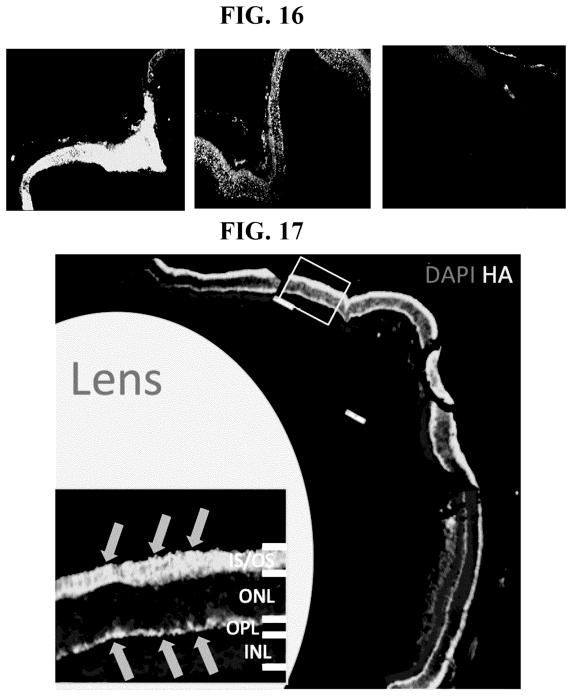 Patent US11793887 Figure 17 – Gene therapy for treating peroxisomal disorders