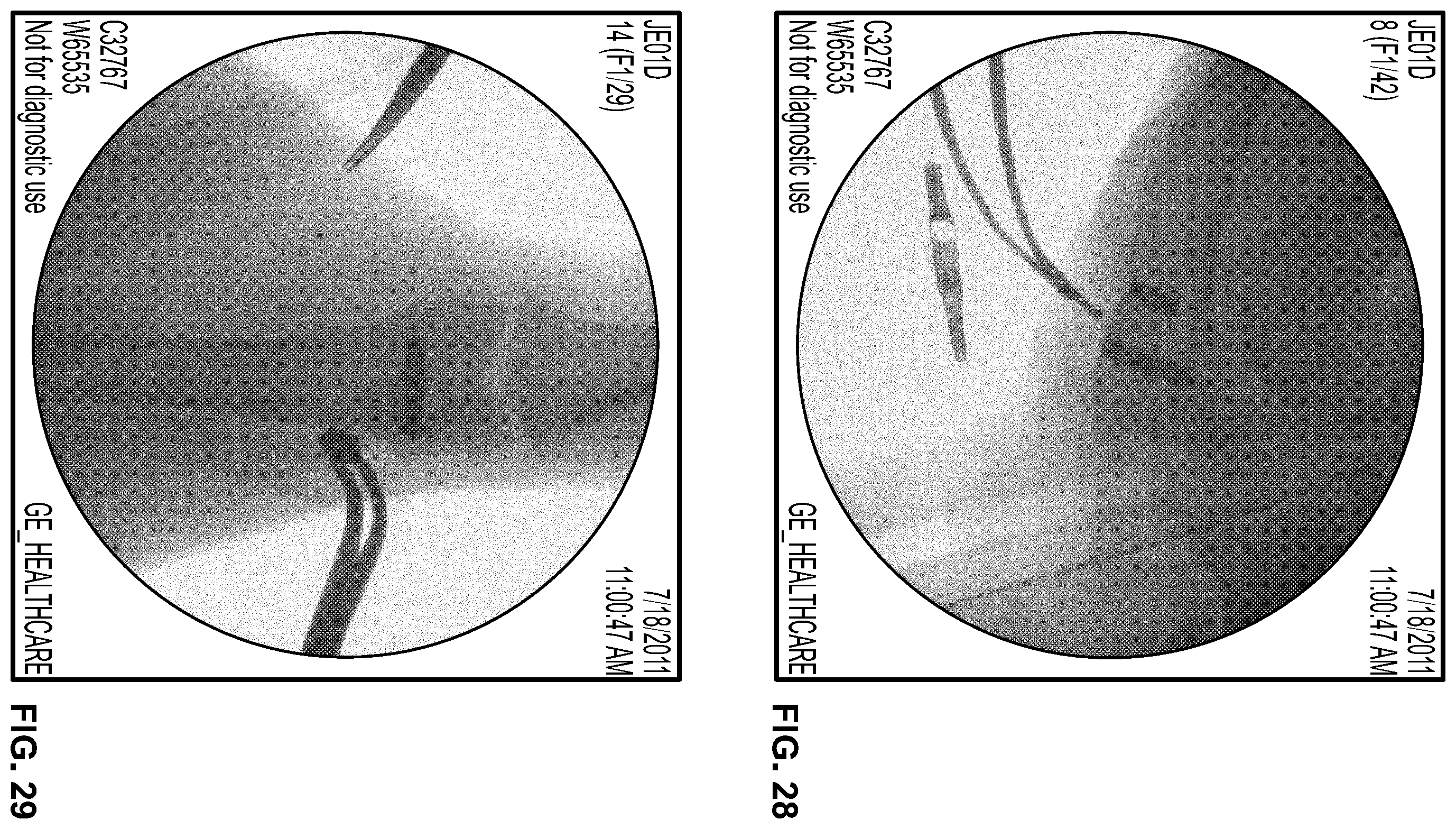 Patent US11793910 Figure 17 – Orthopedic implant having a crystalline calcium phosphate coating and methods for making the same