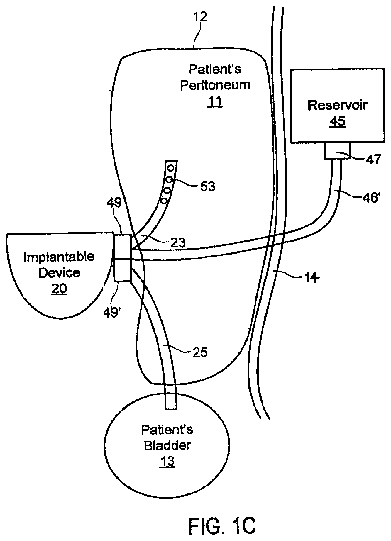 Patent US11793916 Figure 3 – Systems and methods for fluid management