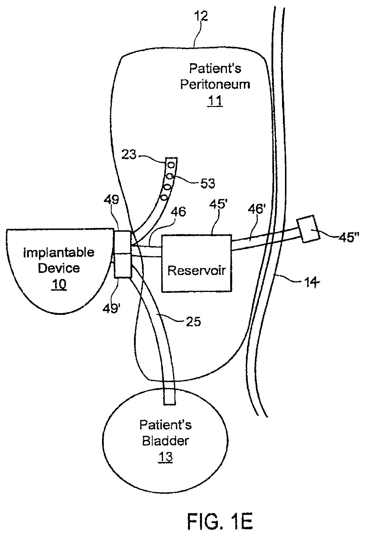 Patent US11793916 Figure 5 – Systems and methods for fluid management