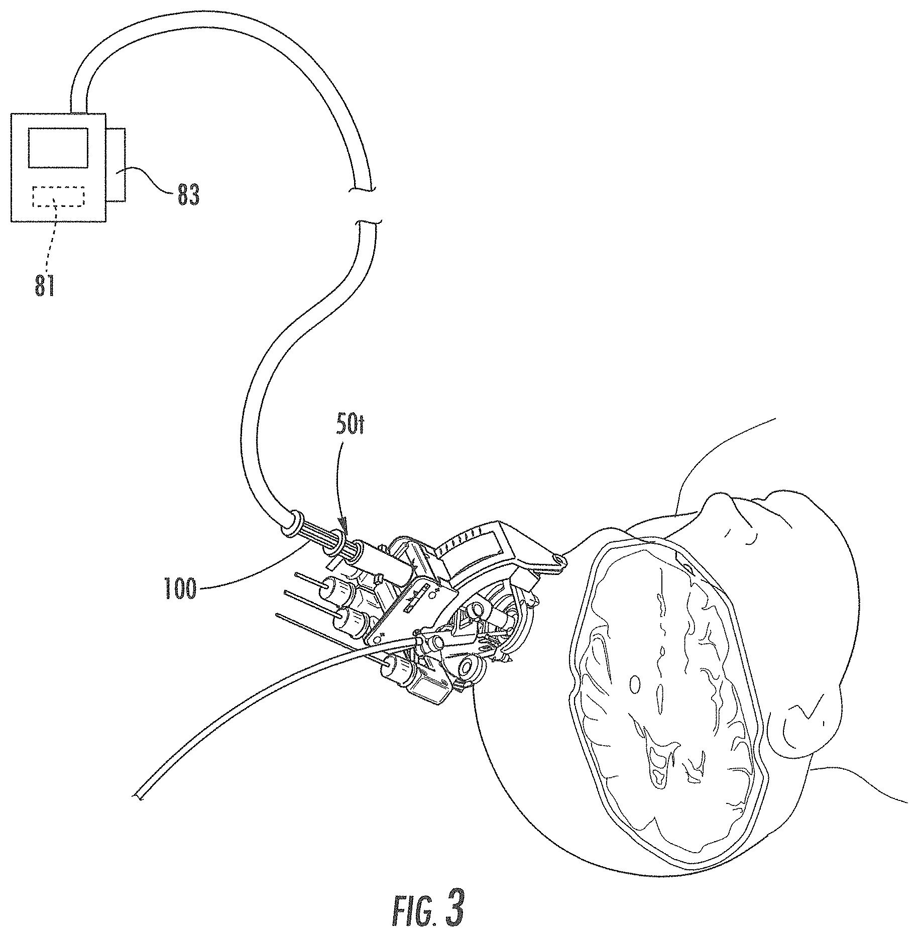 Patent US11793933 Figure 3 – MRI-compatible surgical cannulae for transferring a substance to and/or from a patient