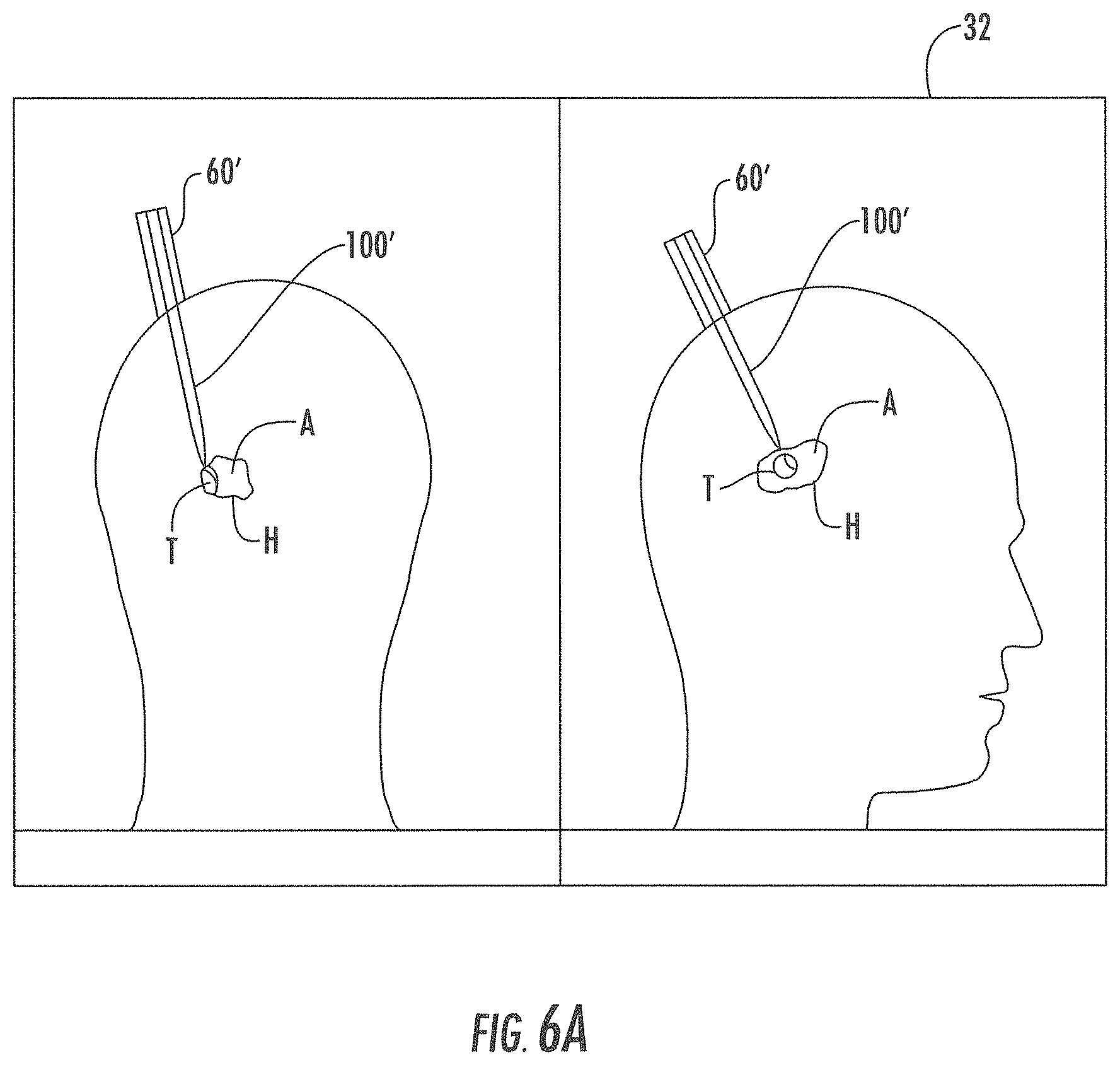 Patent US11793933 Figure 6 – MRI-compatible surgical cannulae for transferring a substance to and/or from a patient