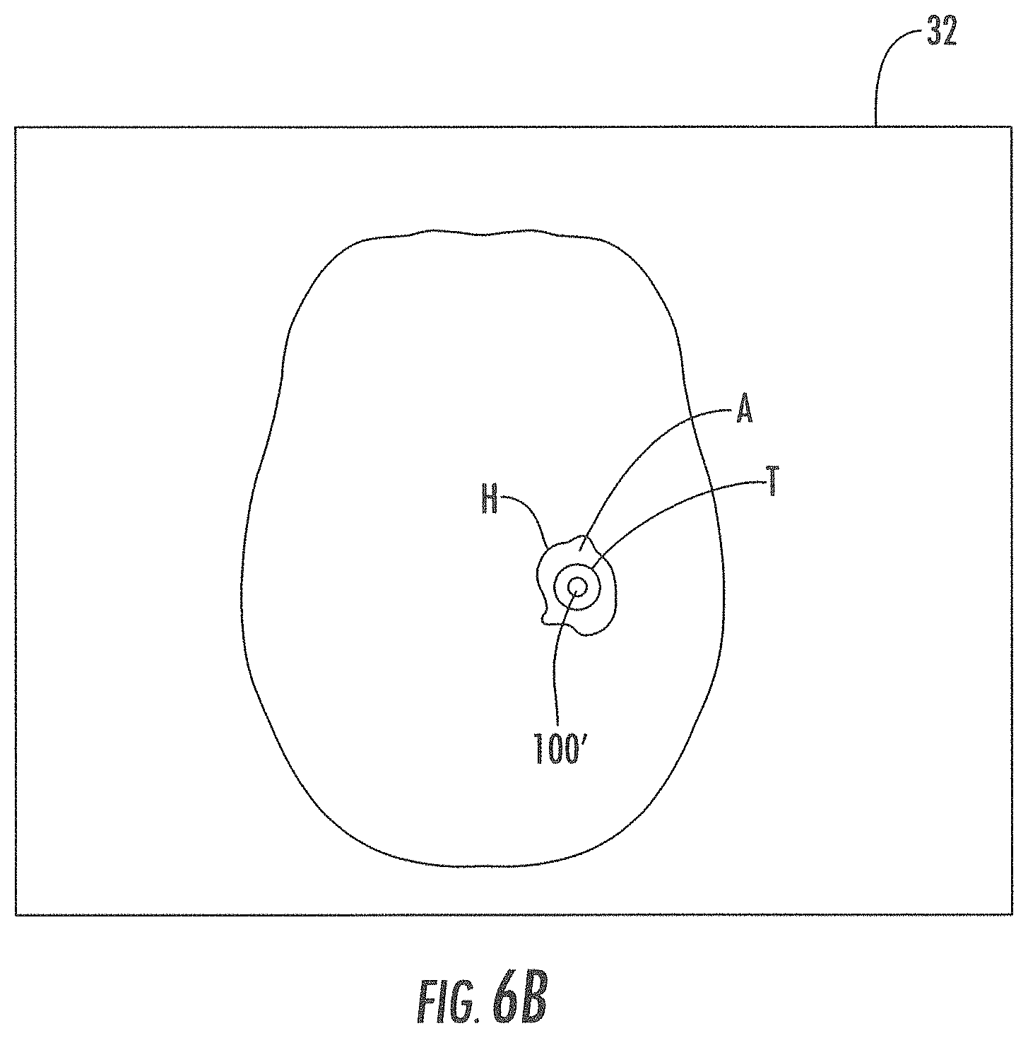 Patent US11793933 Figure 7 – MRI-compatible surgical cannulae for transferring a substance to and/or from a patient