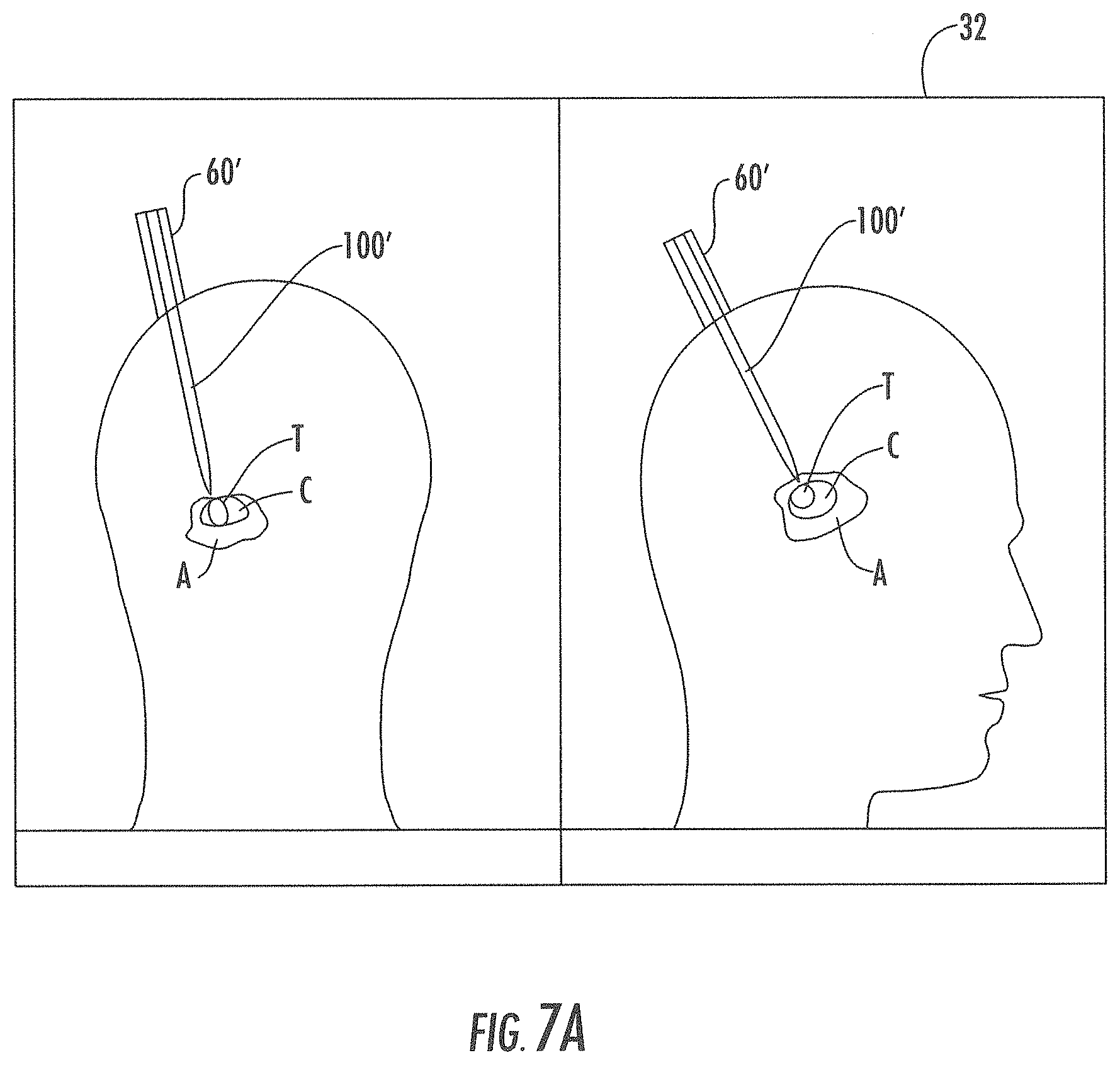 Patent US11793933 Figure 9 – MRI-compatible surgical cannulae for transferring a substance to and/or from a patient