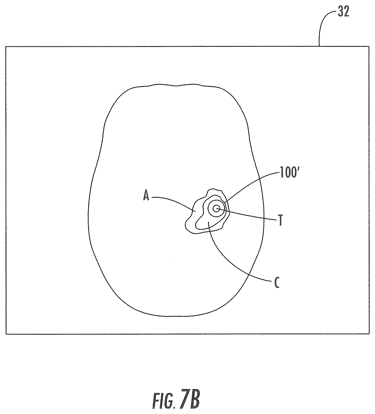Patent US11793933 Figure 10 – MRI-compatible surgical cannulae for transferring a substance to and/or from a patient