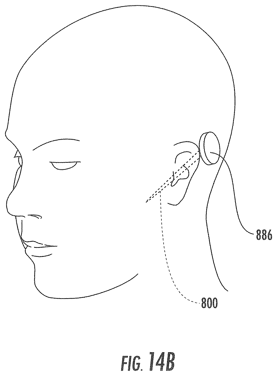 Patent US11793933 Figure 18 – MRI-compatible surgical cannulae for transferring a substance to and/or from a patient