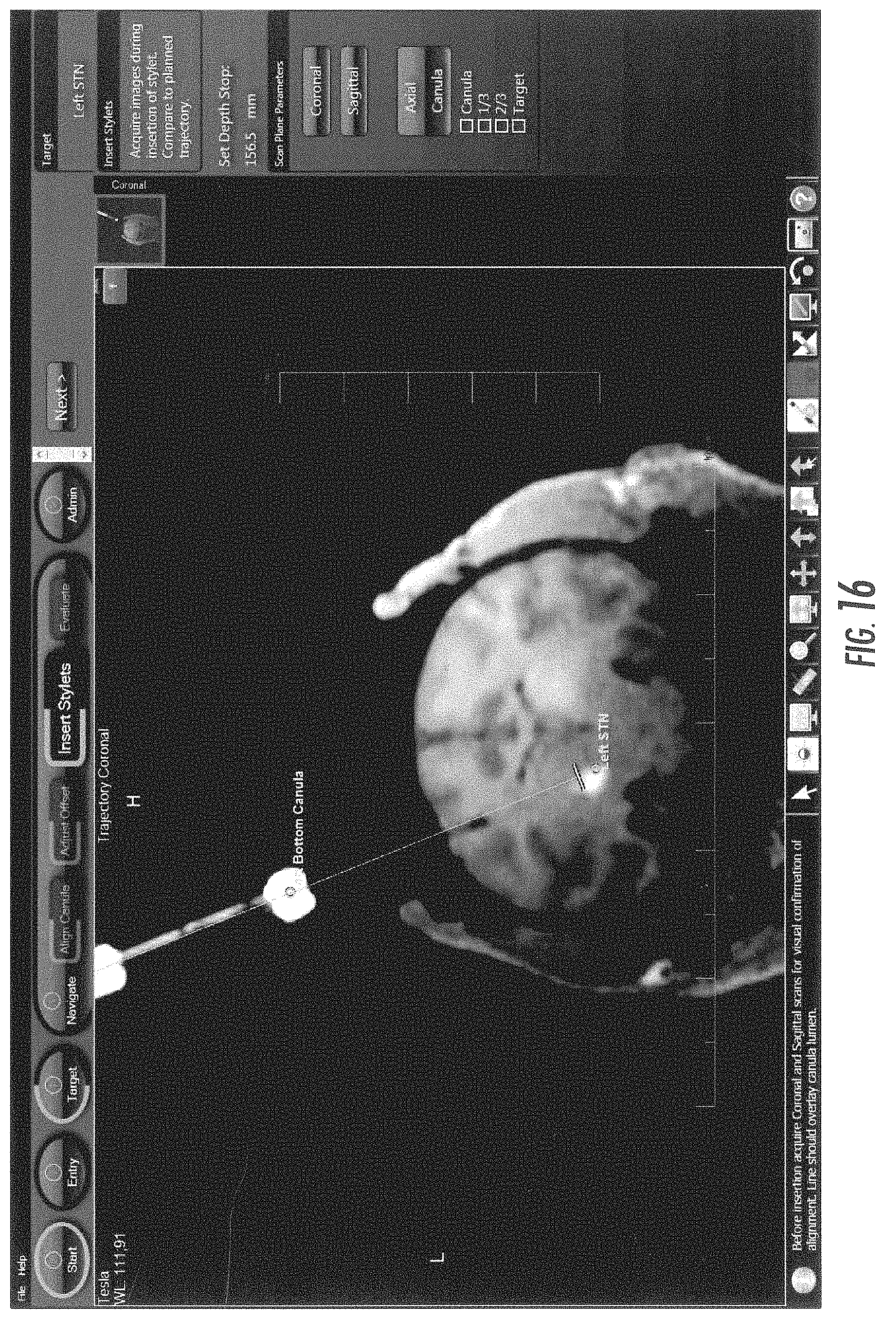 Patent US11793933 Figure 20 – MRI-compatible surgical cannulae for transferring a substance to and/or from a patient