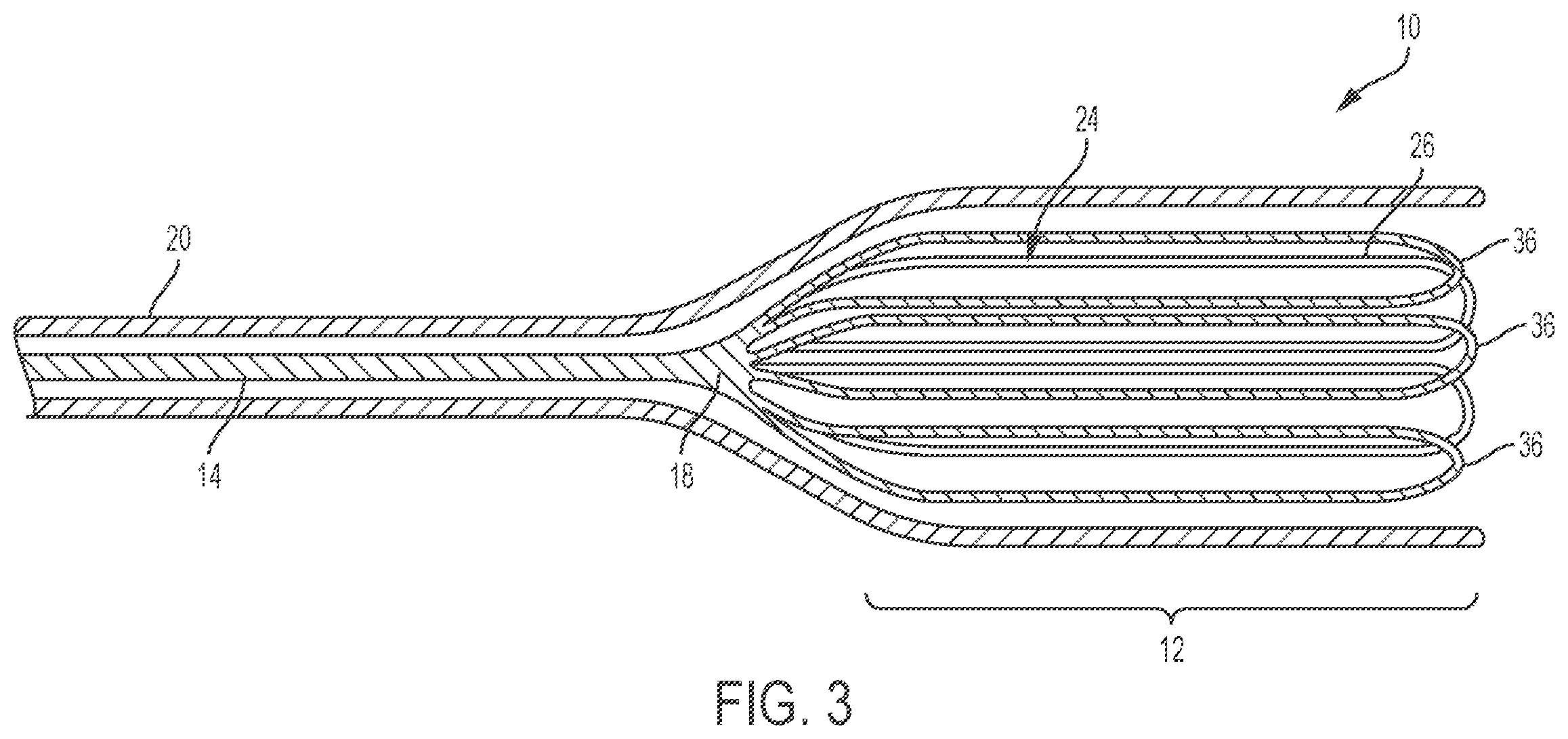 Patent US11793961 Figure 4 – Esophageal temporary occlusion device and method for endotracheal intubation and orogastric tube insertion