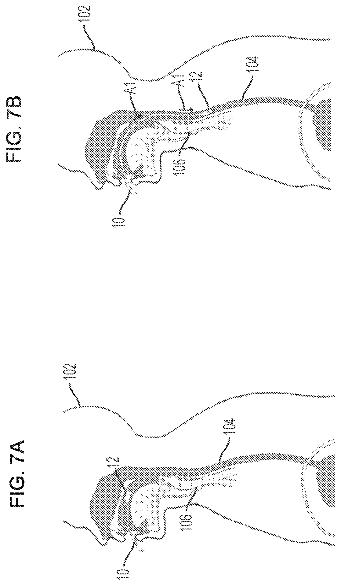 Patent US11793961 Figure 8 – Esophageal temporary occlusion device and method for endotracheal intubation and orogastric tube insertion