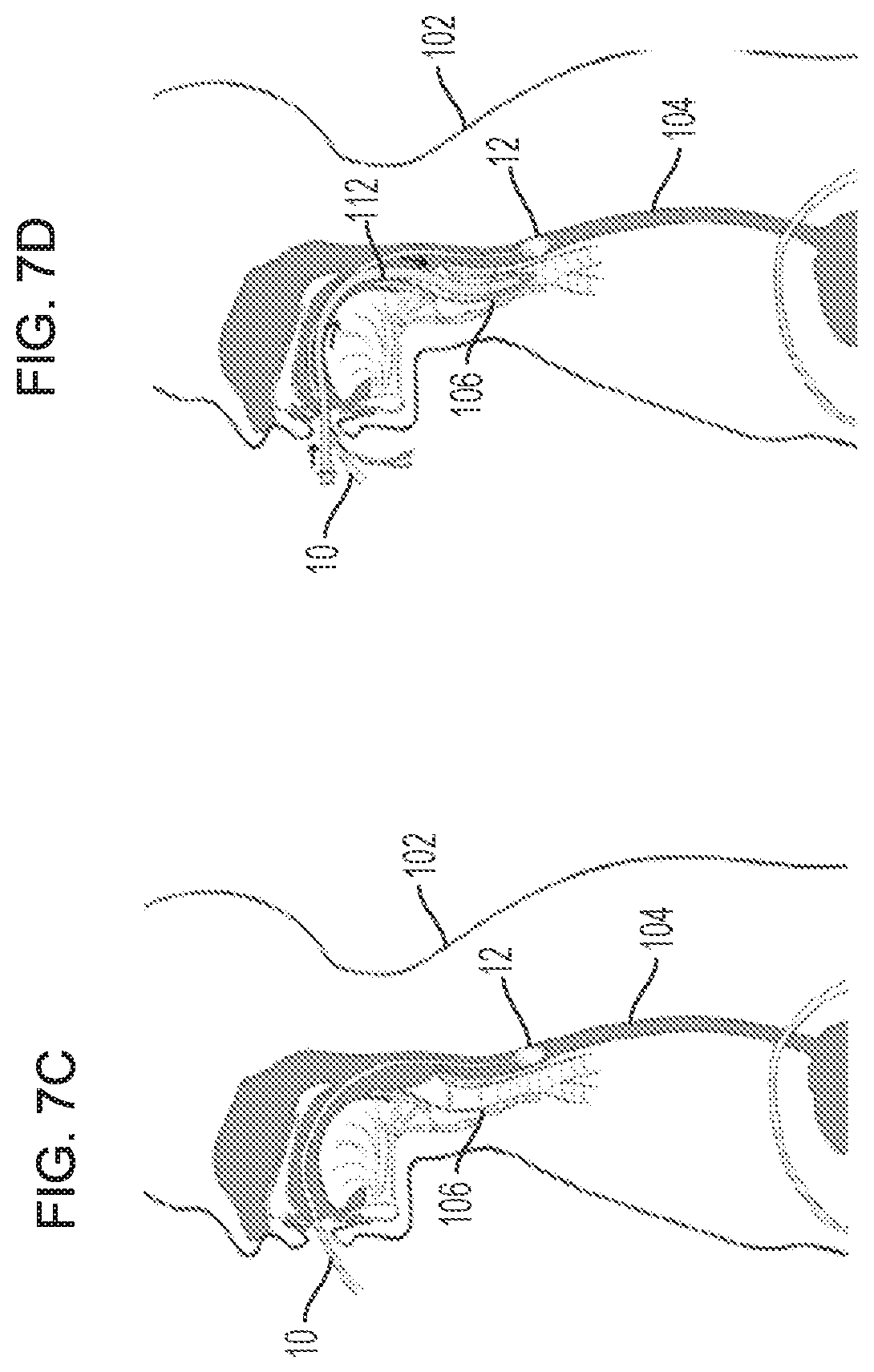 Patent US11793961 Figure 9 – Esophageal temporary occlusion device and method for endotracheal intubation and orogastric tube insertion