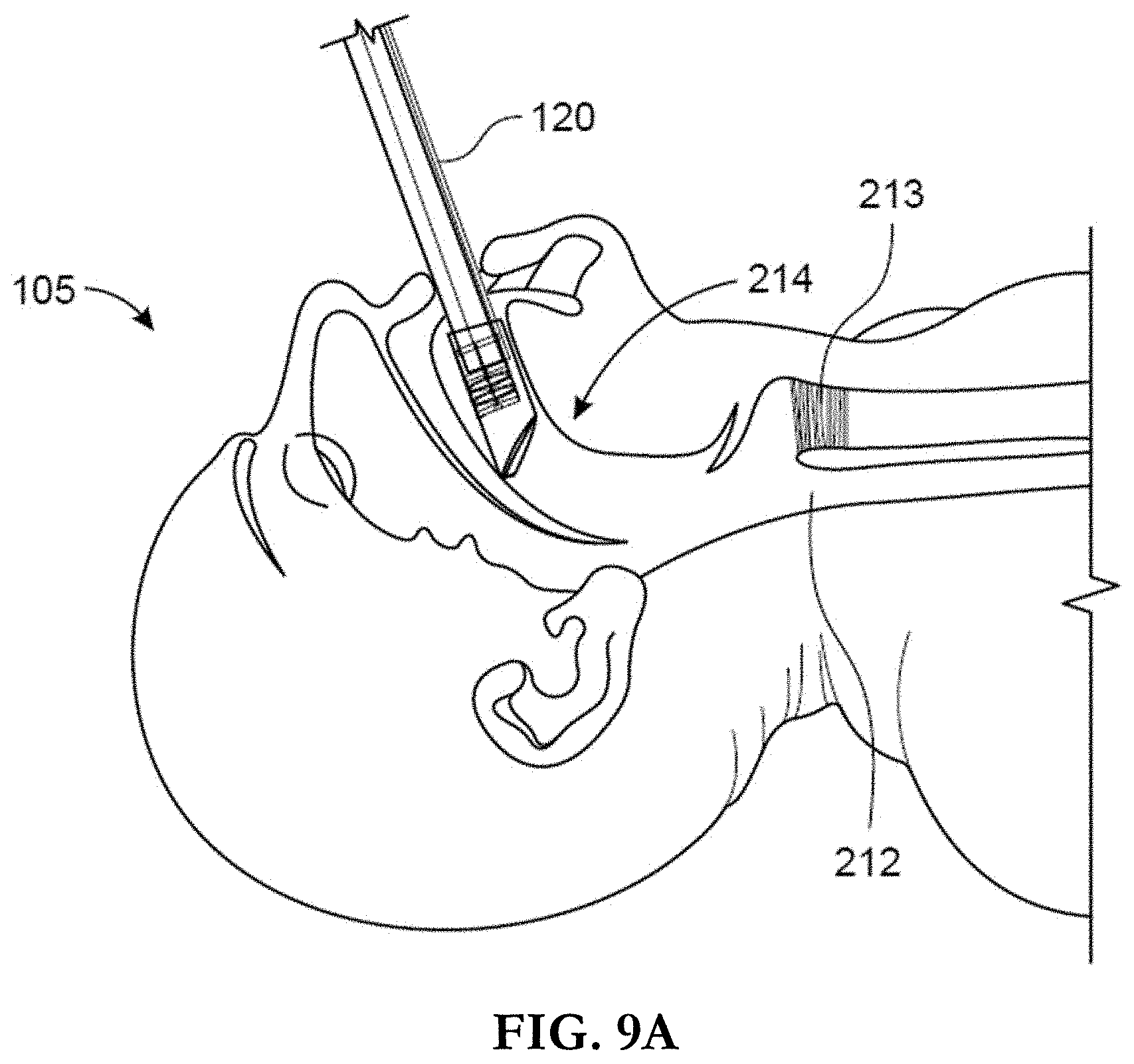 Patent US11793962 Figure 12 – Intubation system, method, and device