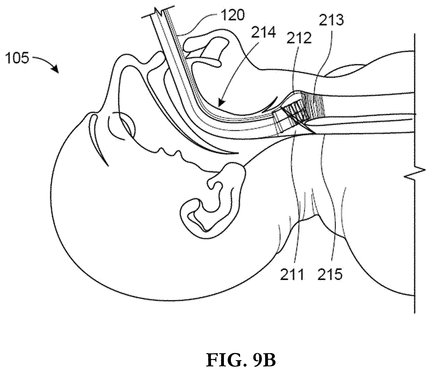 Patent US11793962 Figure 13 – Intubation system, method, and device