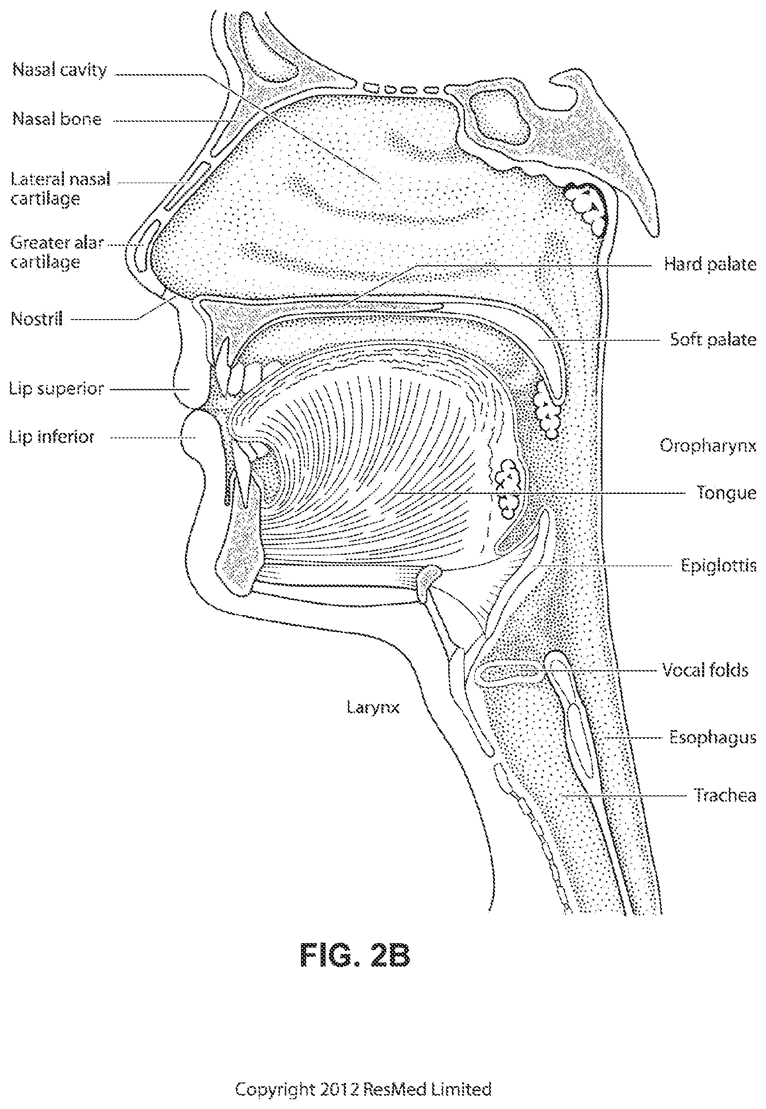 Patent US11793965 Figure 5 – Adjustable headgear tubing for a patient interface