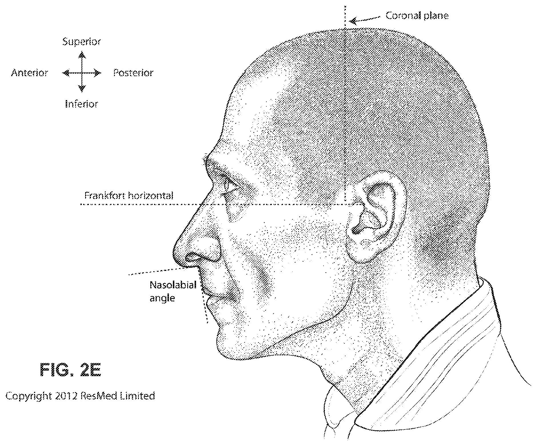 Patent US11793965 Figure 8 – Adjustable headgear tubing for a patient interface