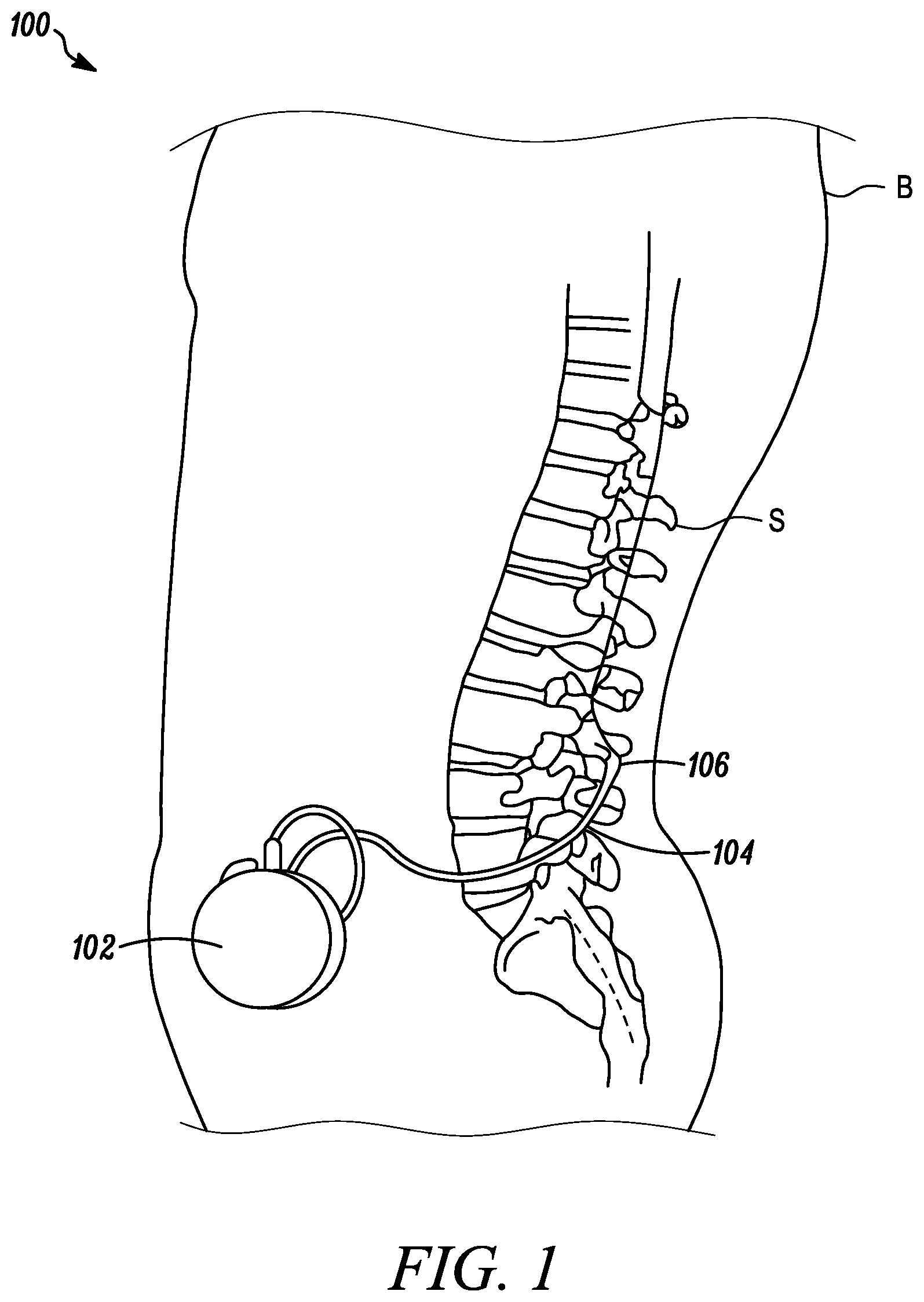 Patent US11793971 Figure 1 – Curved catheter for increased intrathecal drug dispersion