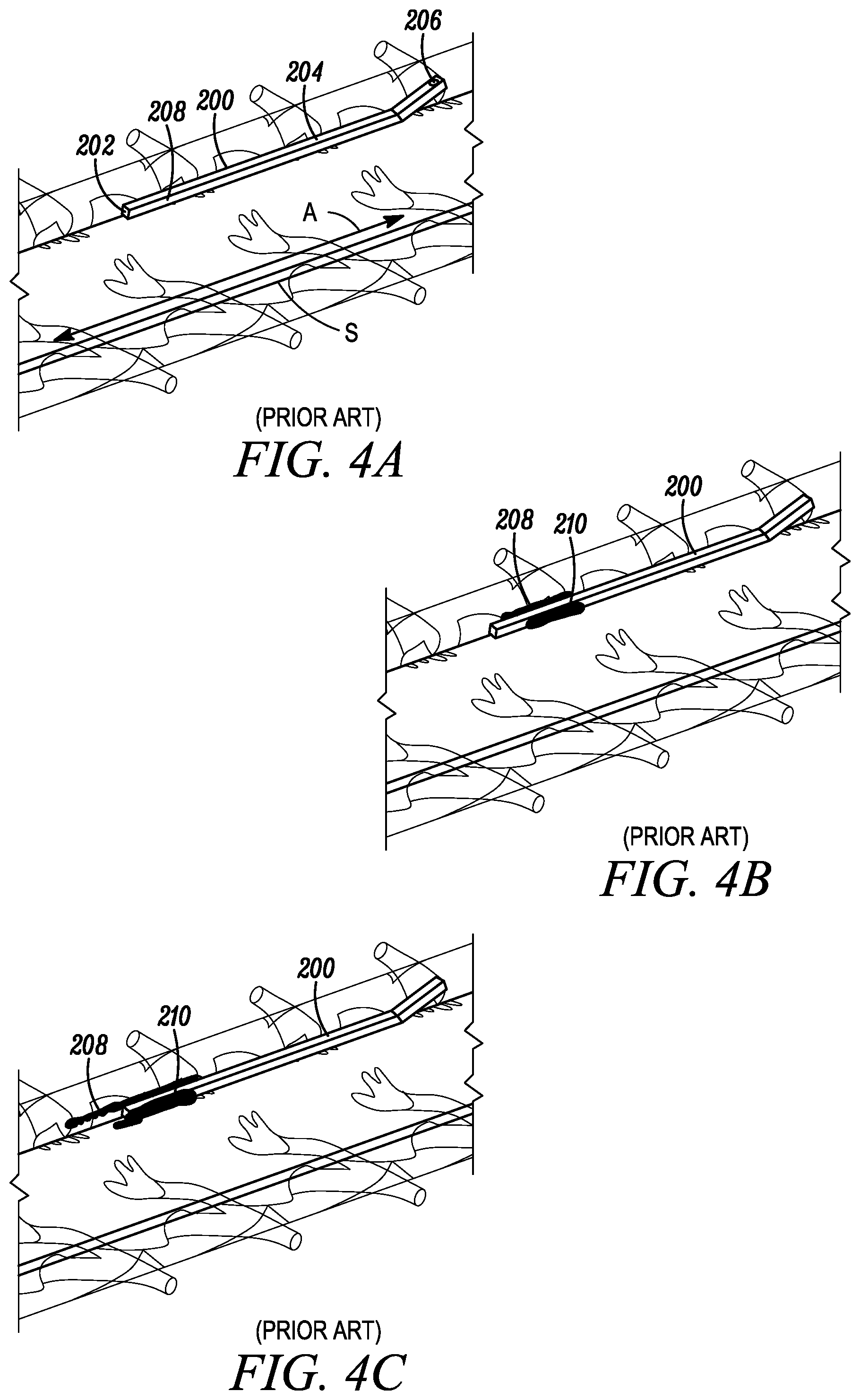 Patent US11793971 Figure 4 – Curved catheter for increased intrathecal drug dispersion