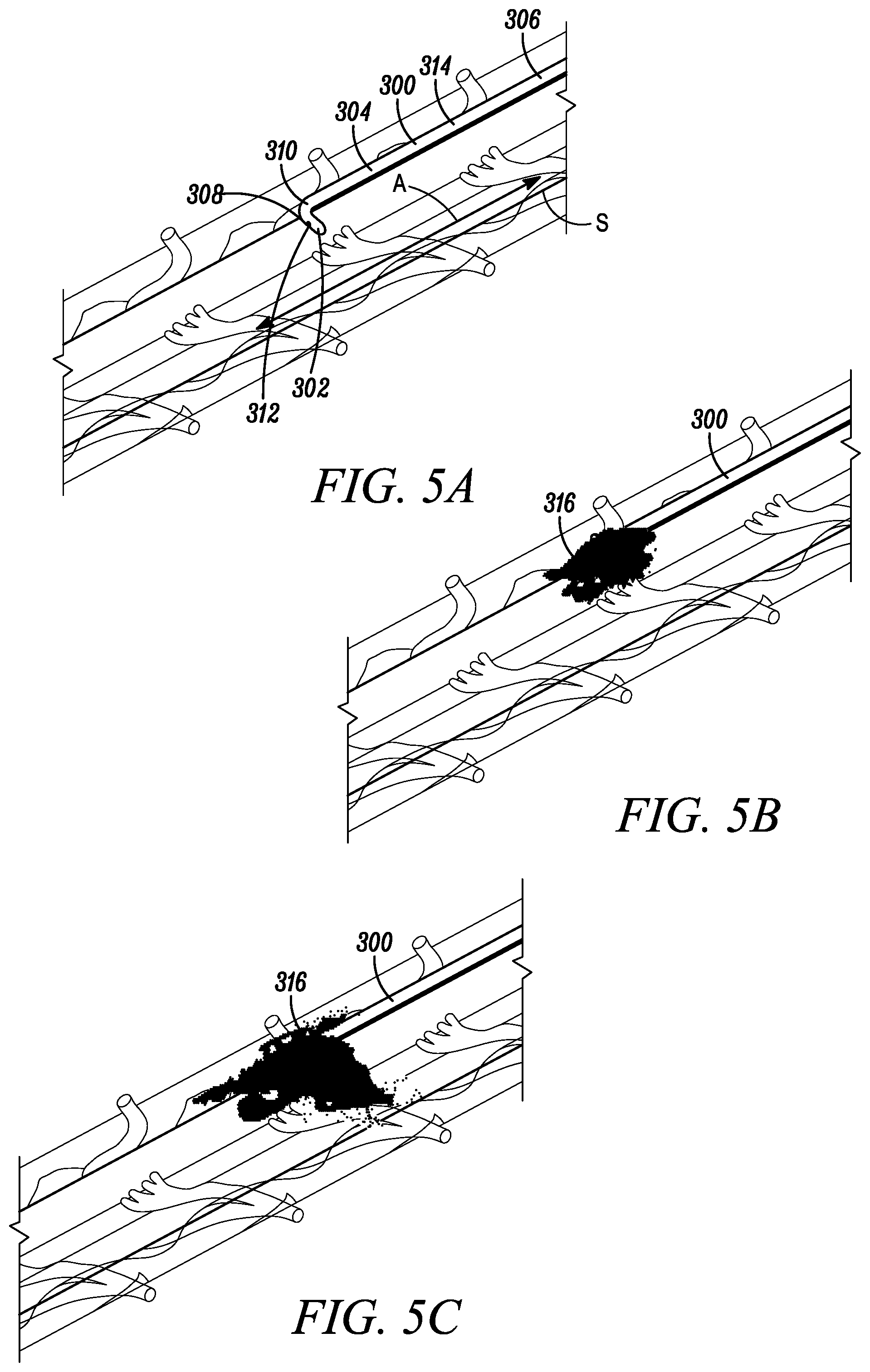 Patent US11793971 Figure 5 – Curved catheter for increased intrathecal drug dispersion