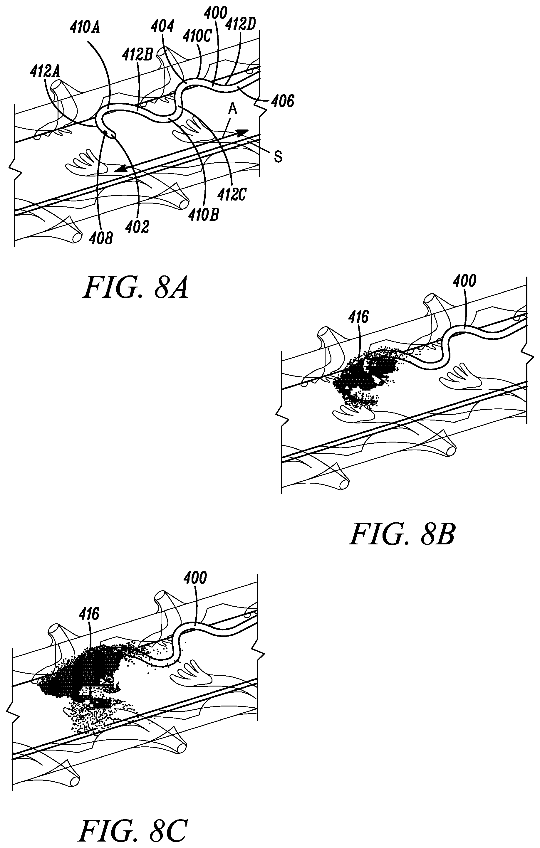 Patent US11793971 Figure 7 – Curved catheter for increased intrathecal drug dispersion