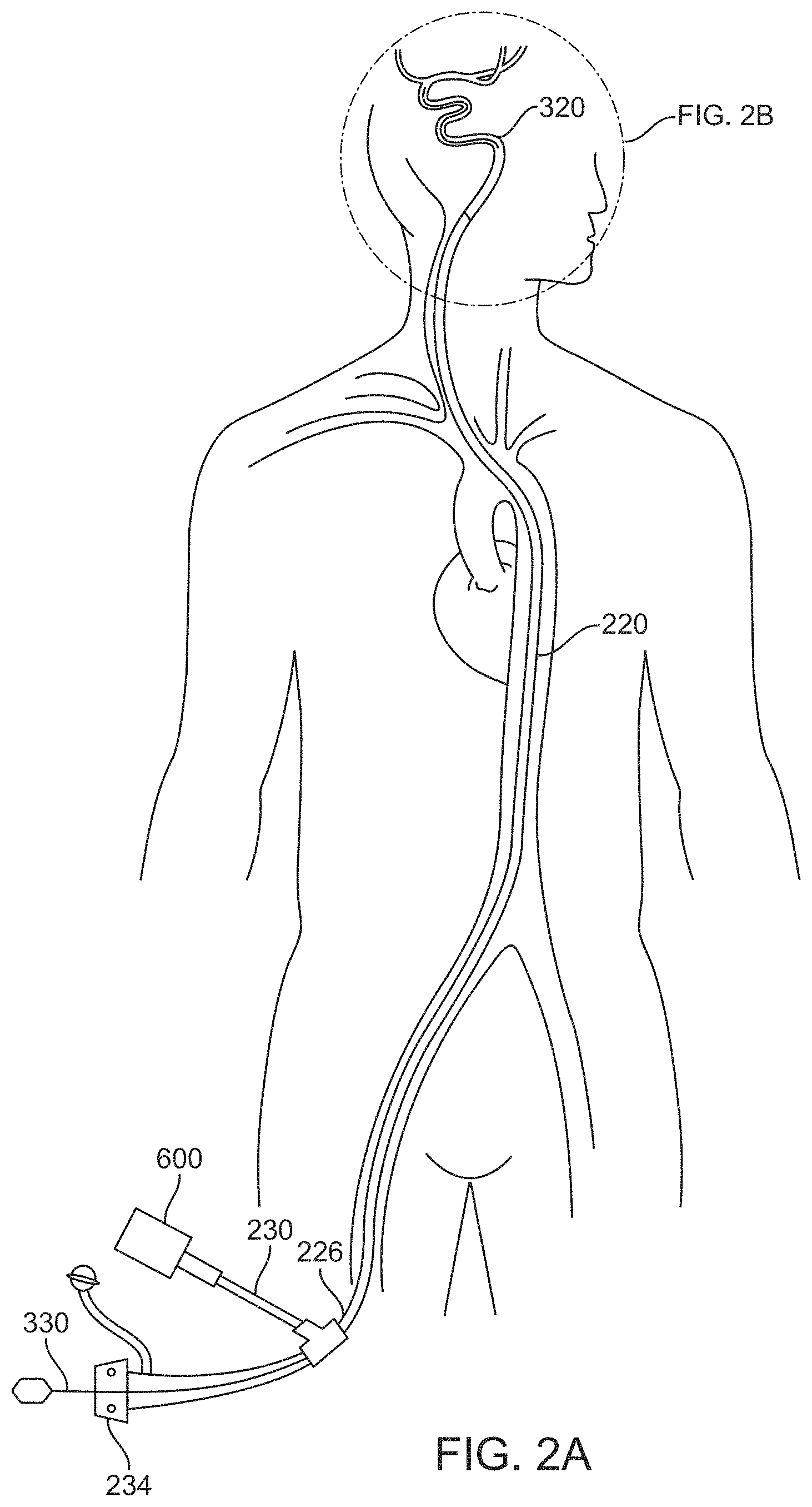 Patent US11793972 Figure 2 – Rapid aspiration thrombectomy system and method