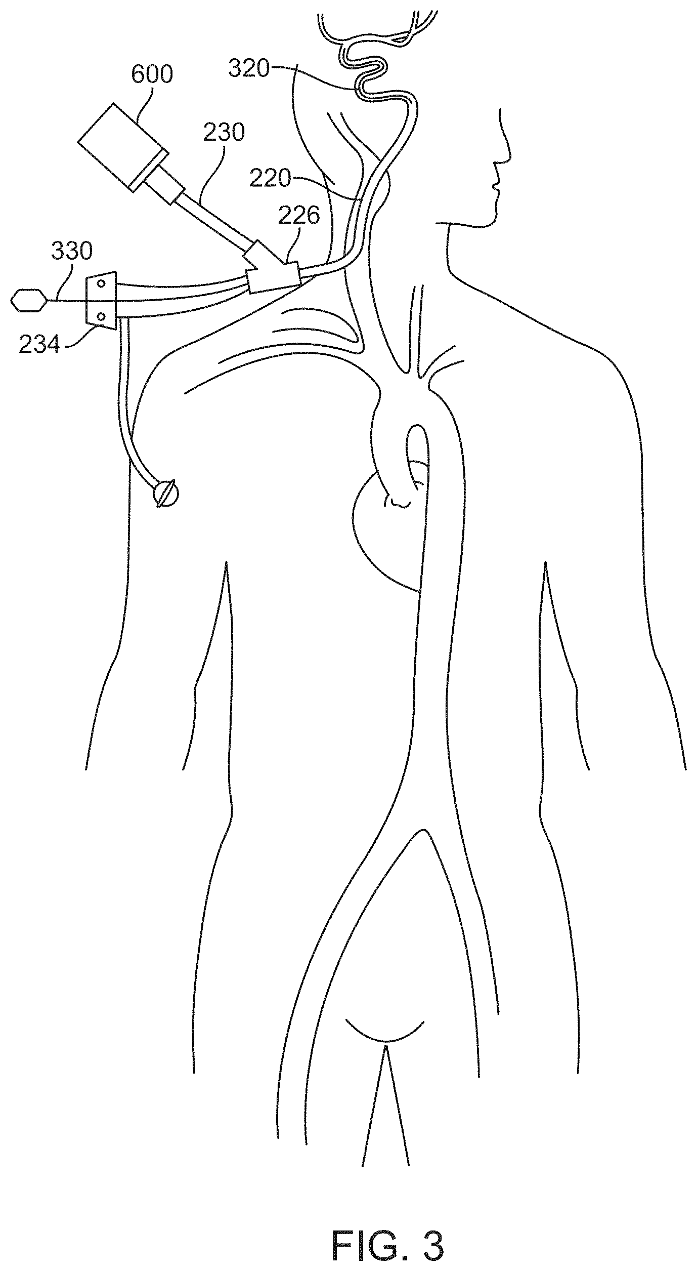 Patent US11793972 Figure 4 – Rapid aspiration thrombectomy system and method