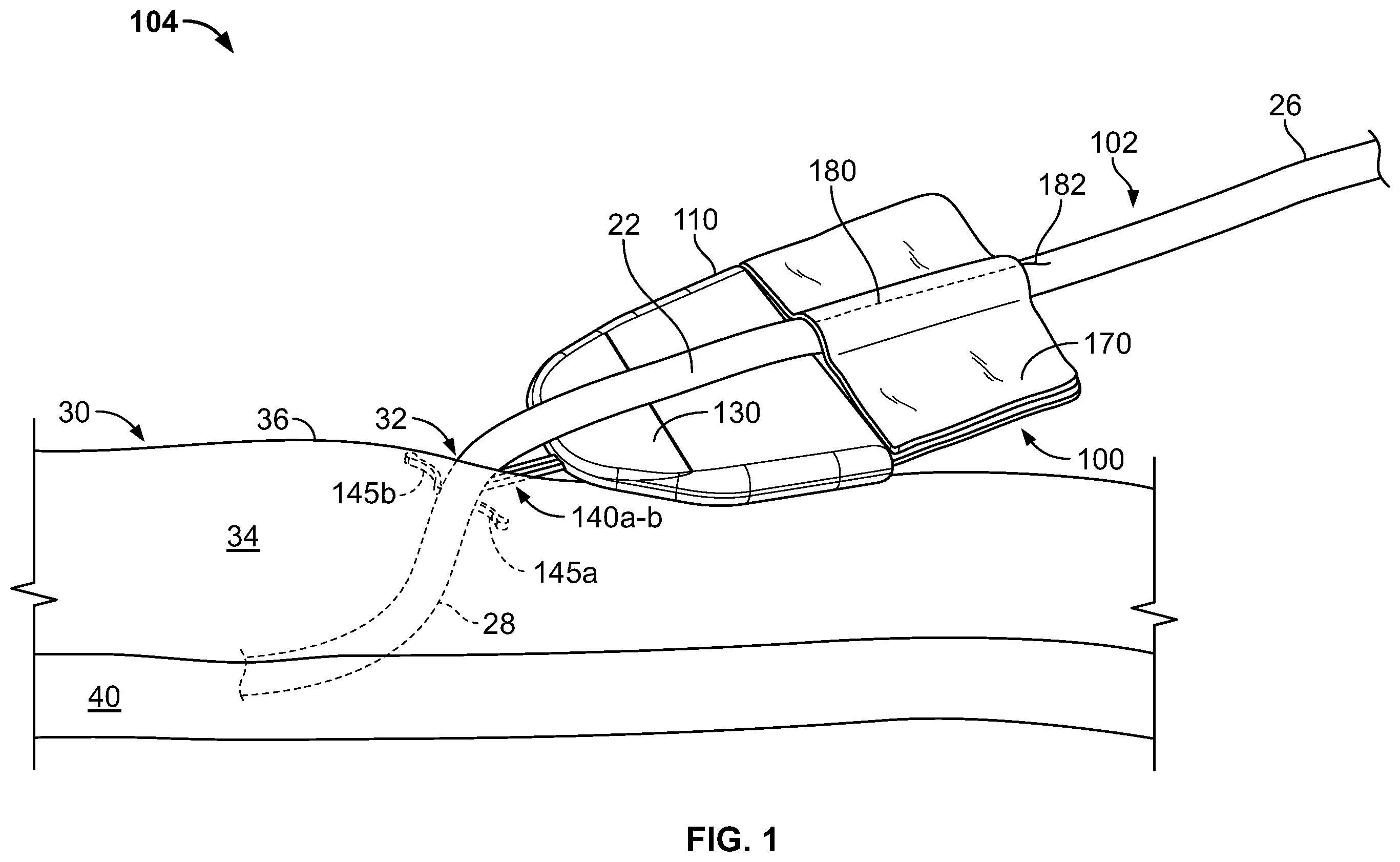 Patent US11793975 Figure 1 – Systems and methods for anchoring medical devices