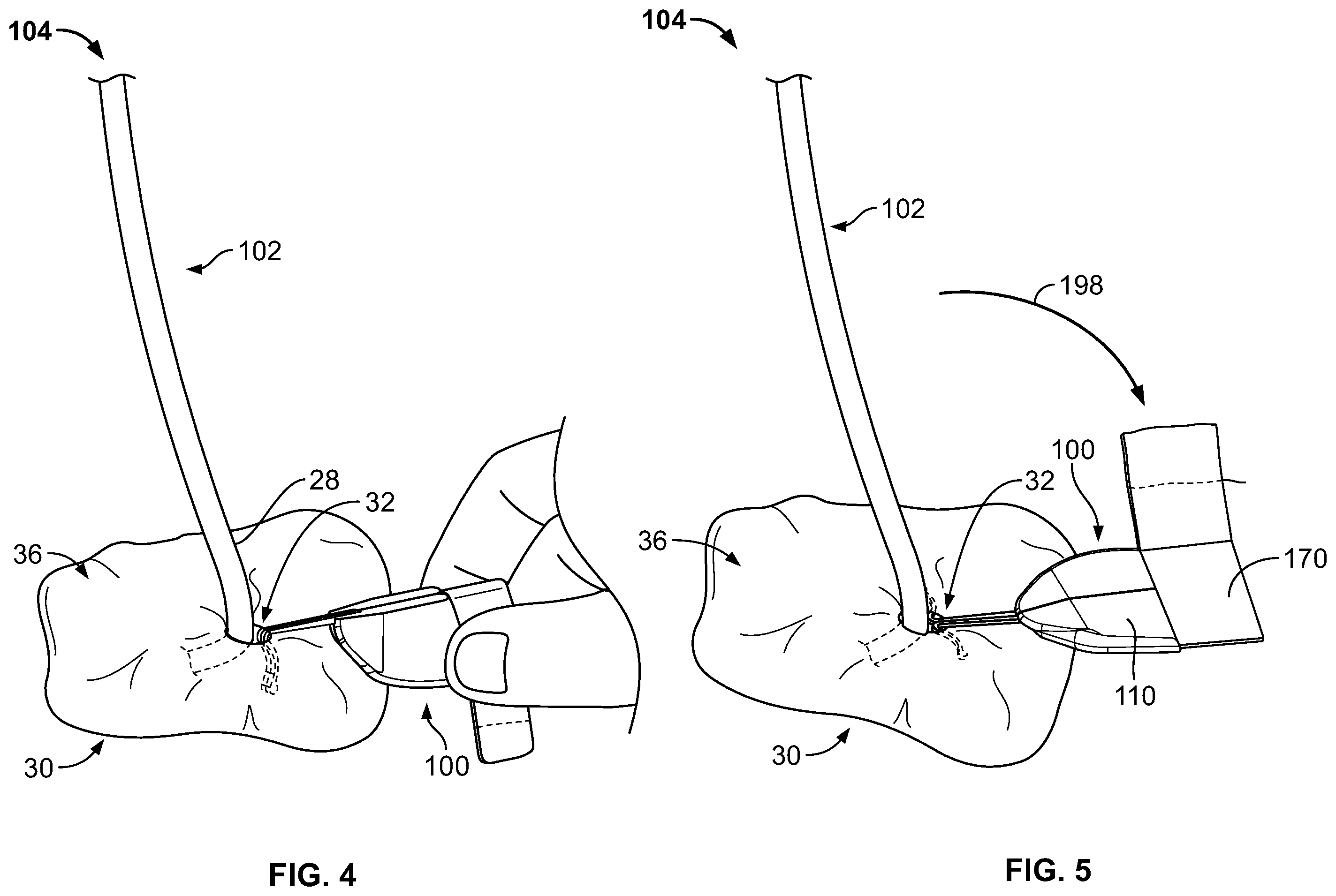 Patent US11793975 Figure 4 – Systems and methods for anchoring medical devices