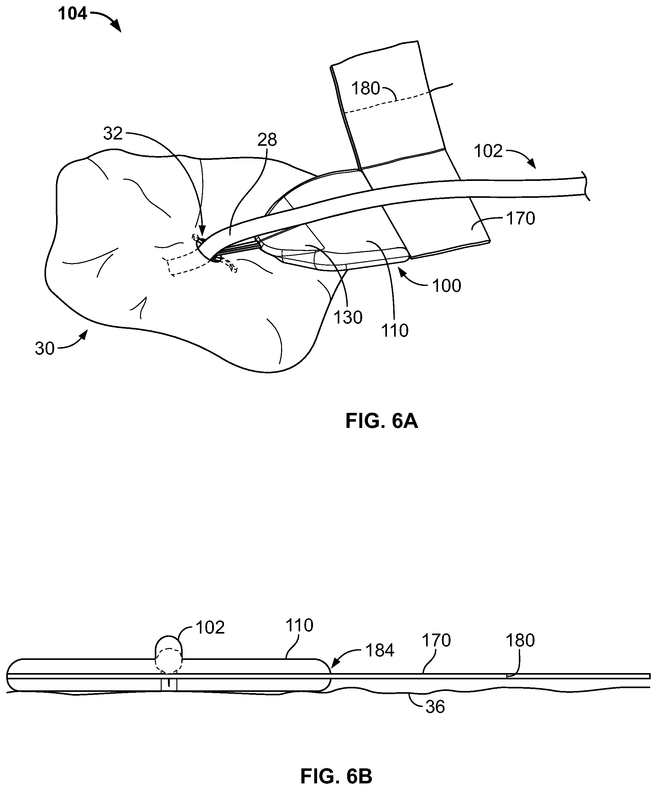 Patent US11793975 Figure 5 – Systems and methods for anchoring medical devices
