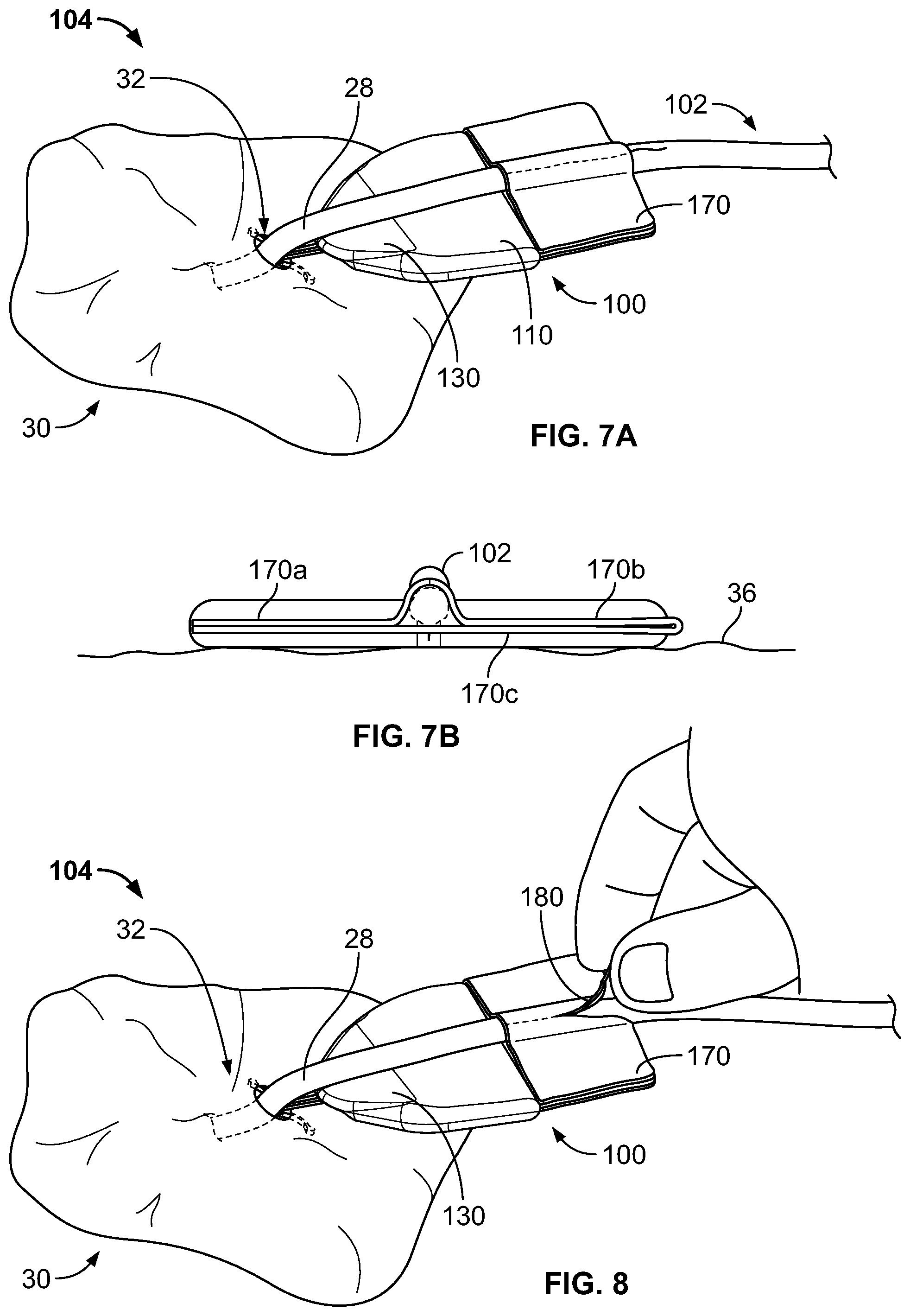 Patent US11793975 Figure 6 – Systems and methods for anchoring medical devices