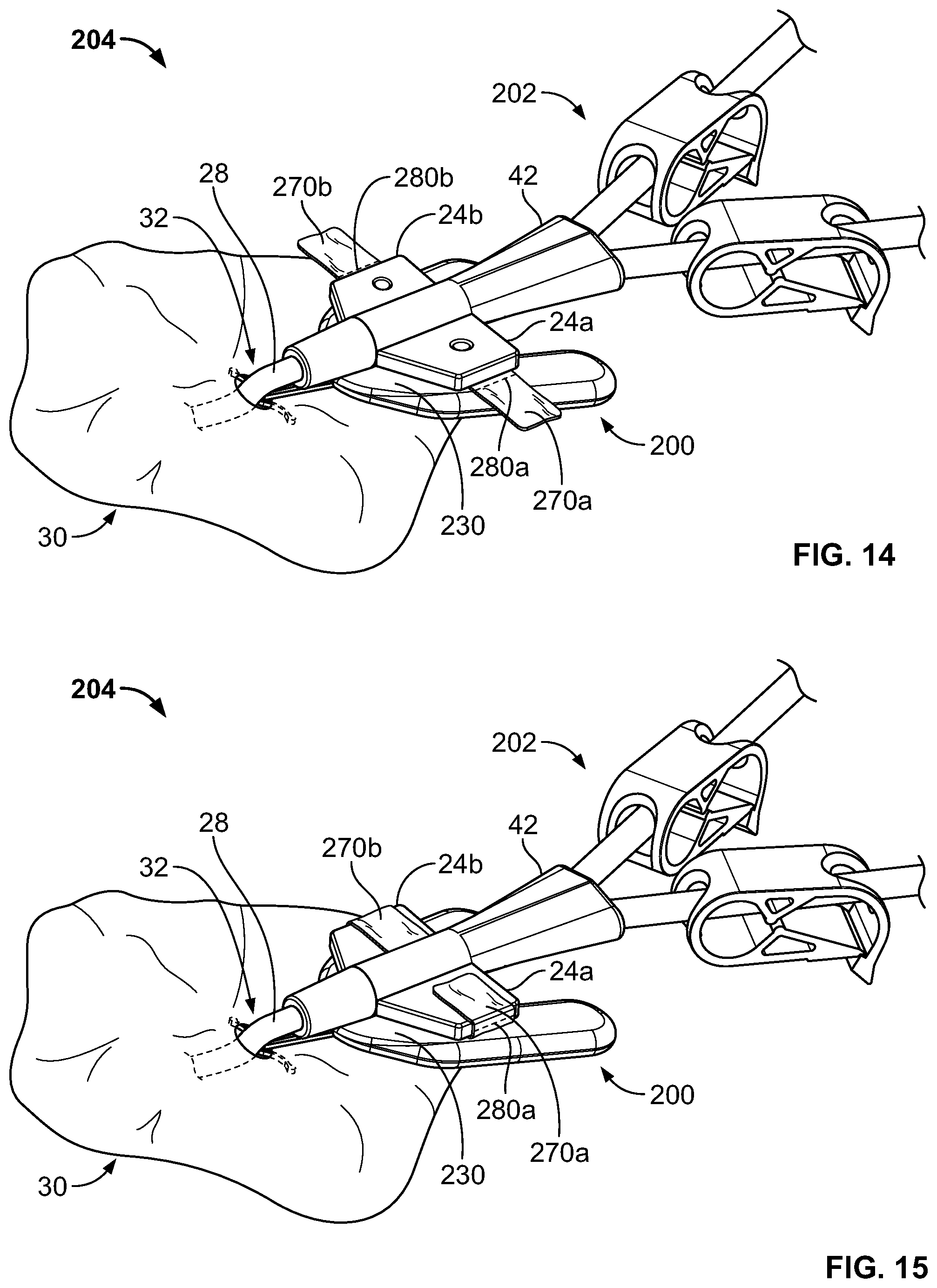 Patent US11793975 Figure 12 – Systems and methods for anchoring medical devices
