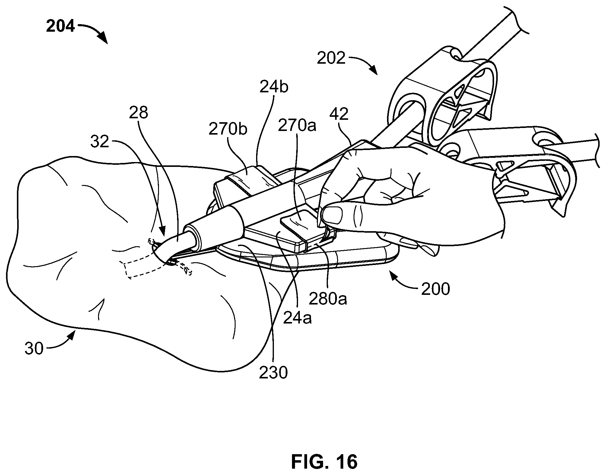 Patent US11793975 Figure 13 – Systems and methods for anchoring medical devices