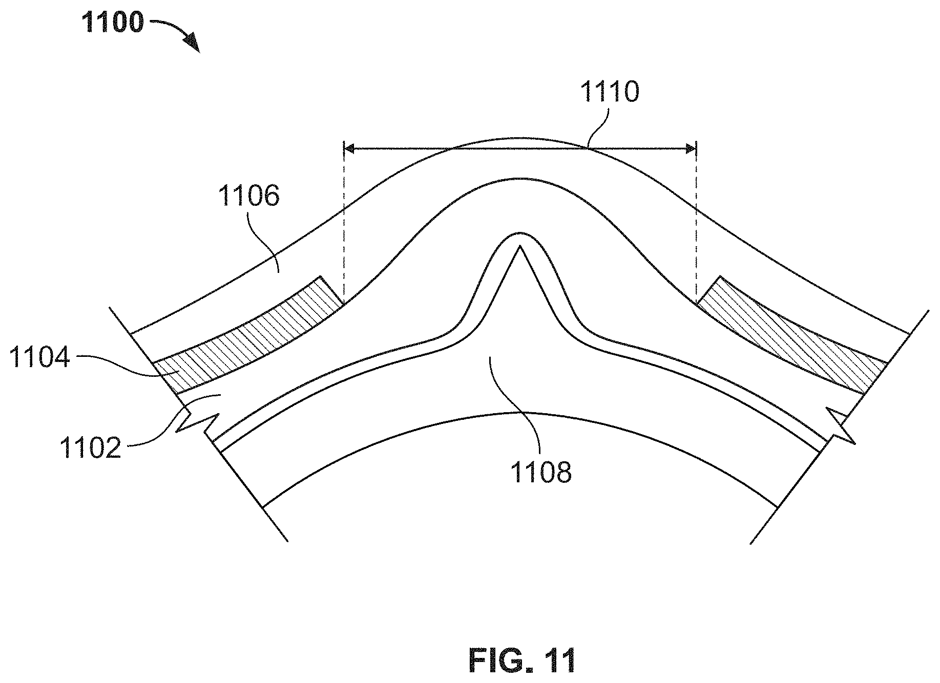Patent US11793977 Figure 11 – Peel-away sheath assembly