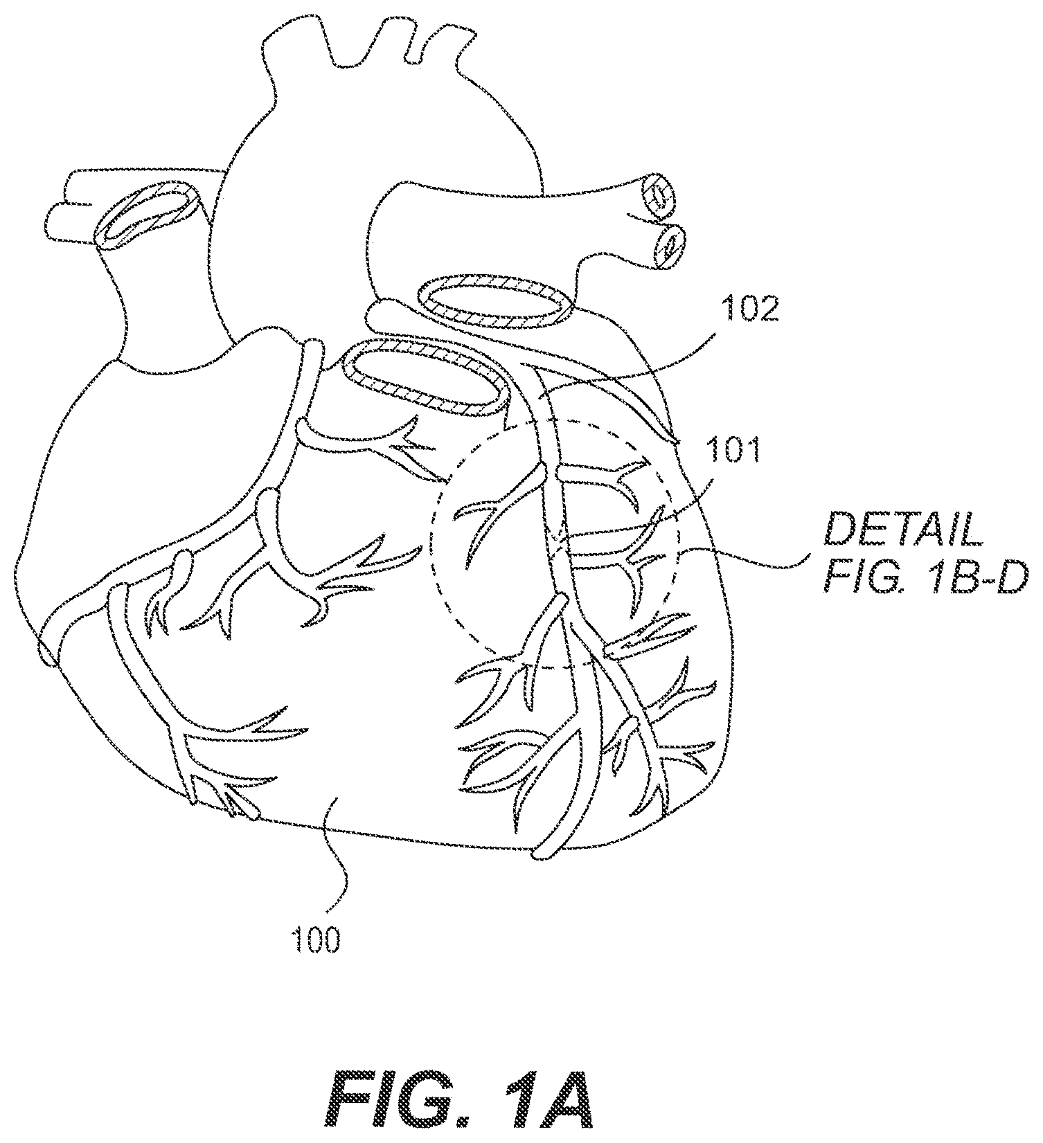 Patent US11793978 Figure 1 – Endovascular devices and methods