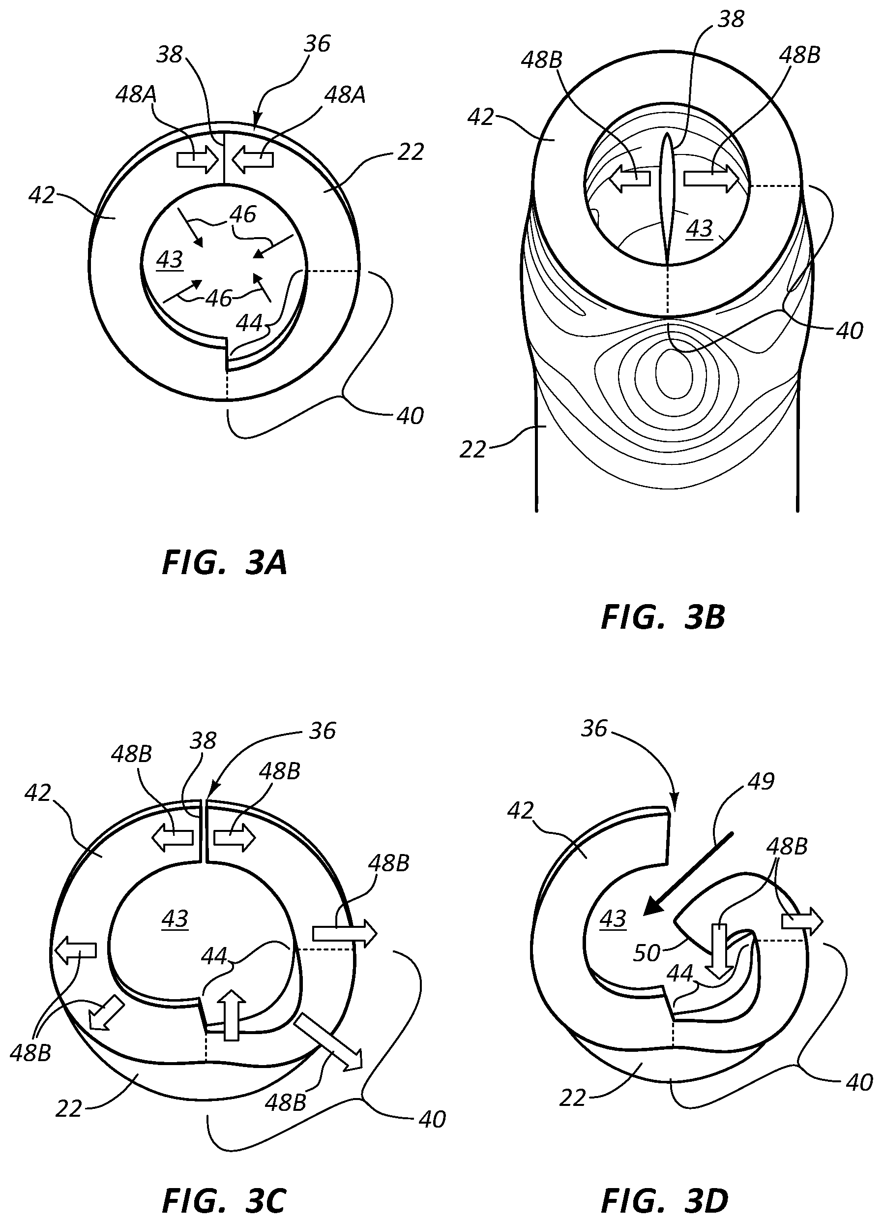 Patent US11793989 Figure 4 – Distal valve for a catheter