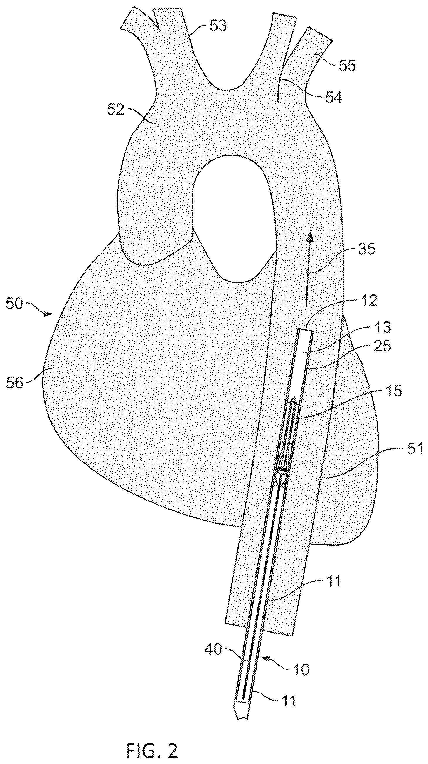 Patent US11793991 Figure 2 – Linear cardiac assist pulsatile pump