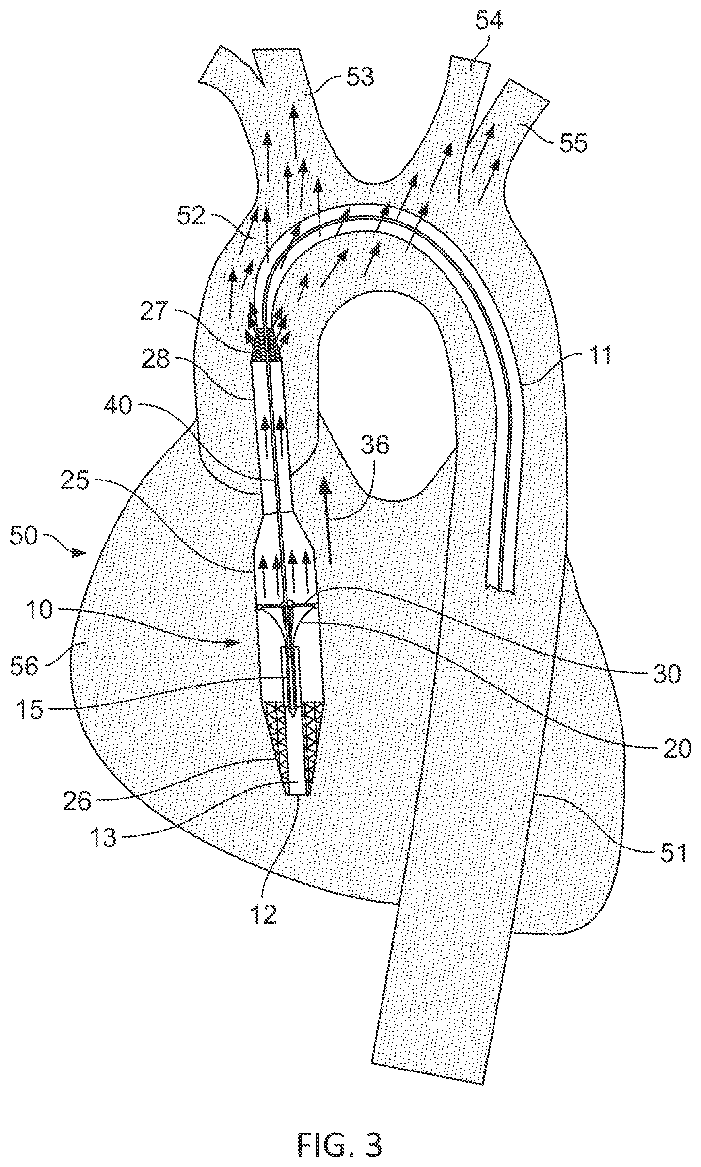Patent US11793991 Figure 3 – Linear cardiac assist pulsatile pump
