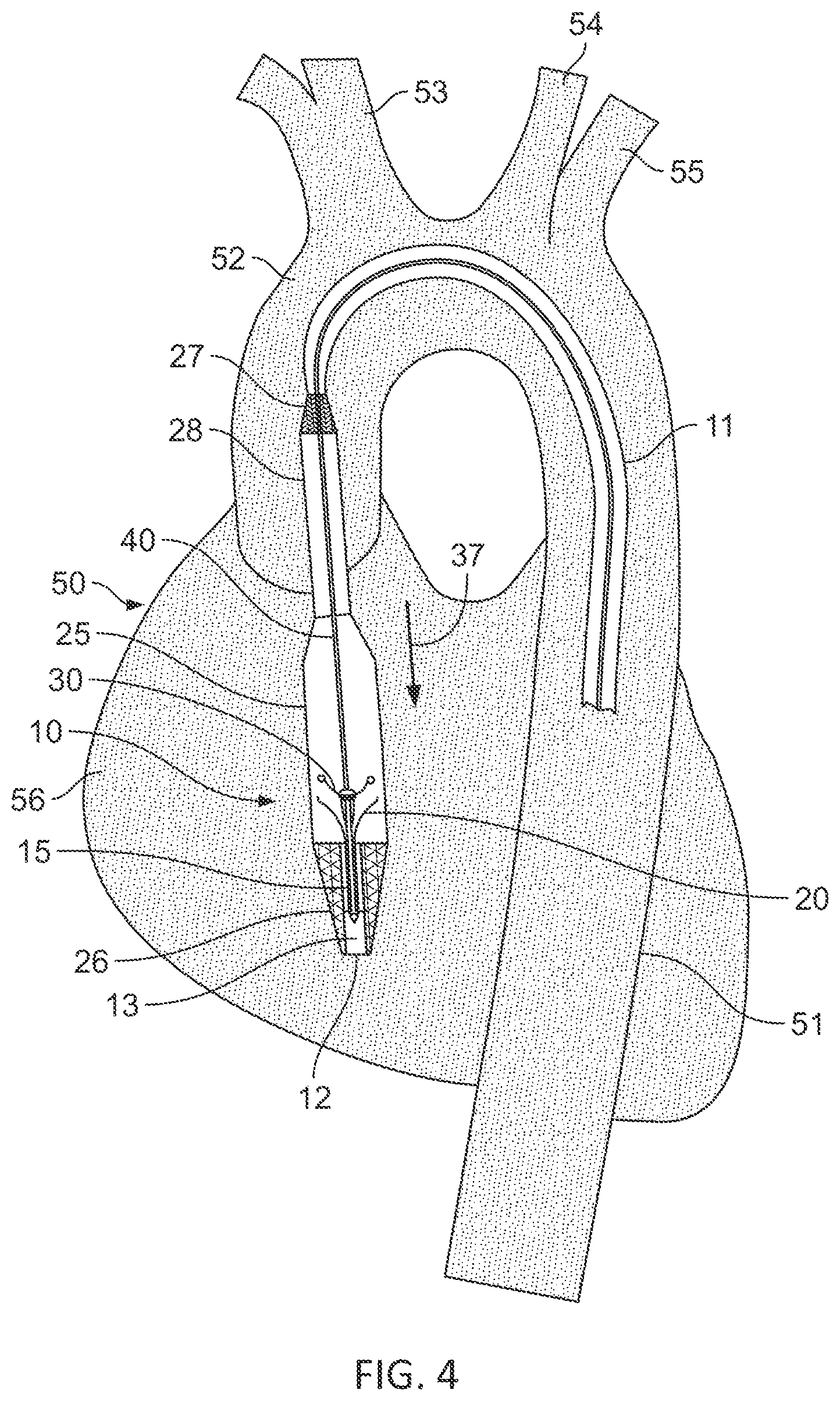 Patent US11793991 Figure 4 – Linear cardiac assist pulsatile pump