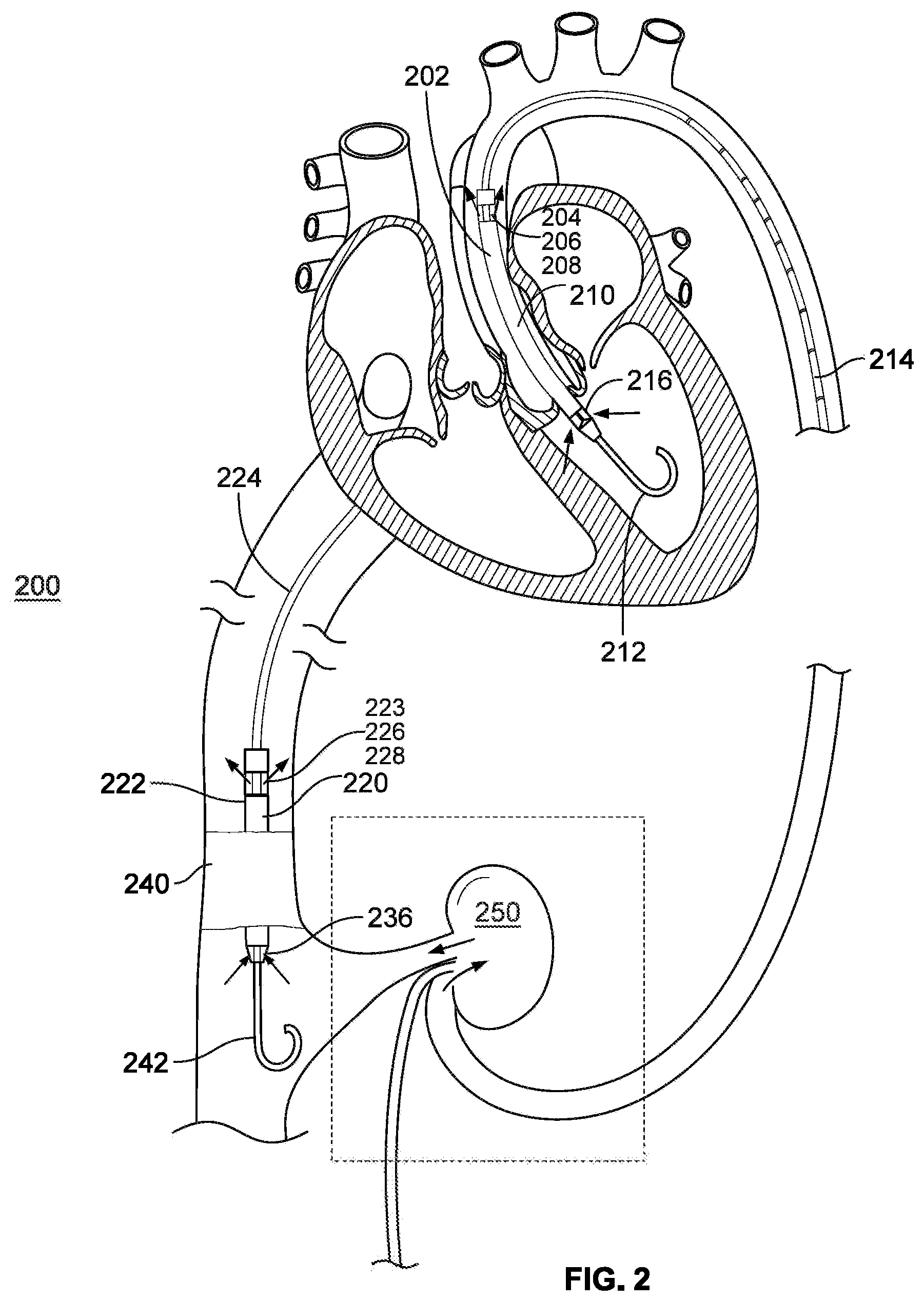 Patent US11793994 Figure 2 – Use of cardiac assist device to improve kidney function
