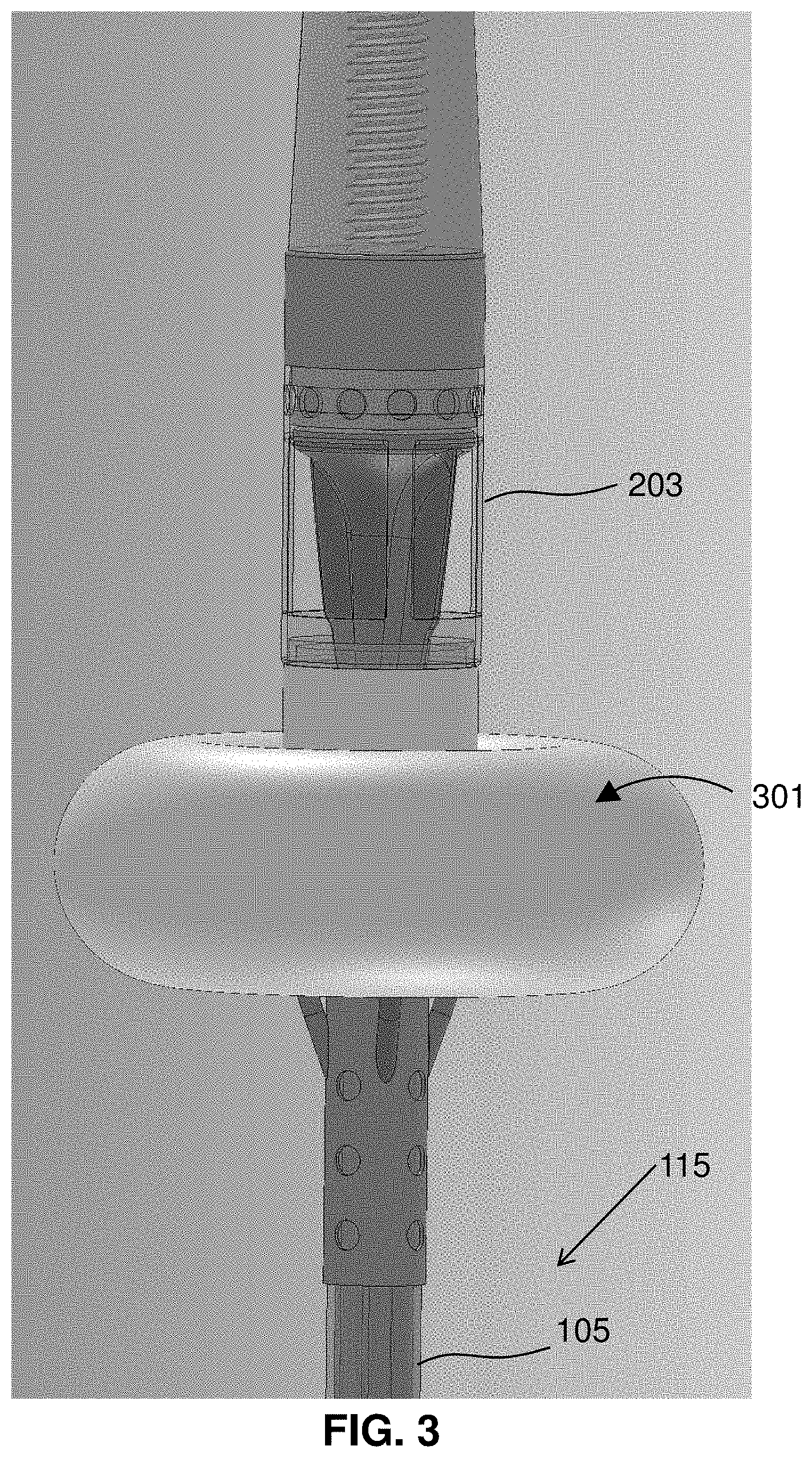 Patent US11793996 Figure 3 – Devices and methods for treating edema