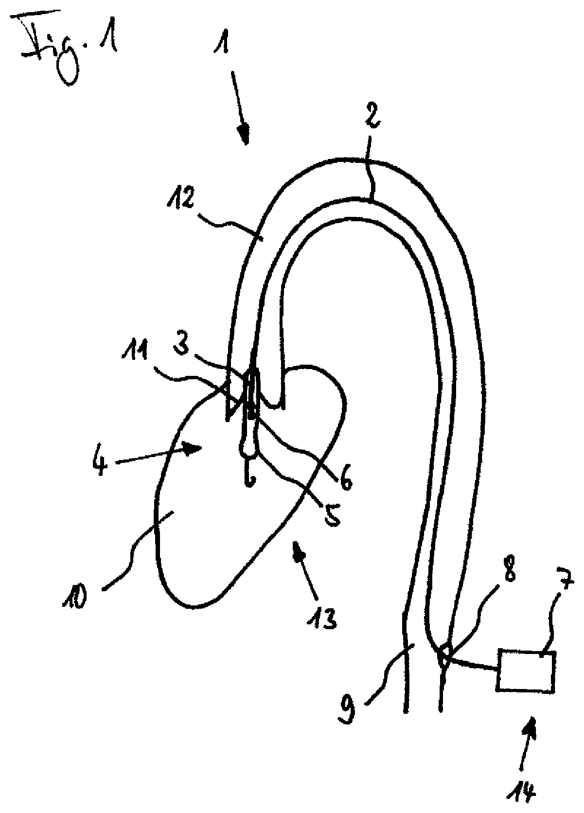 Patent US11793997 — Pump, in particular a blood pump — Figure 1