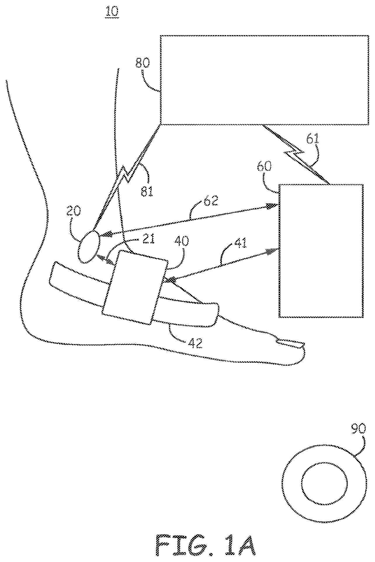 Patent US11793998 Figure 1 – Minimally invasive implantable neurostimulation system