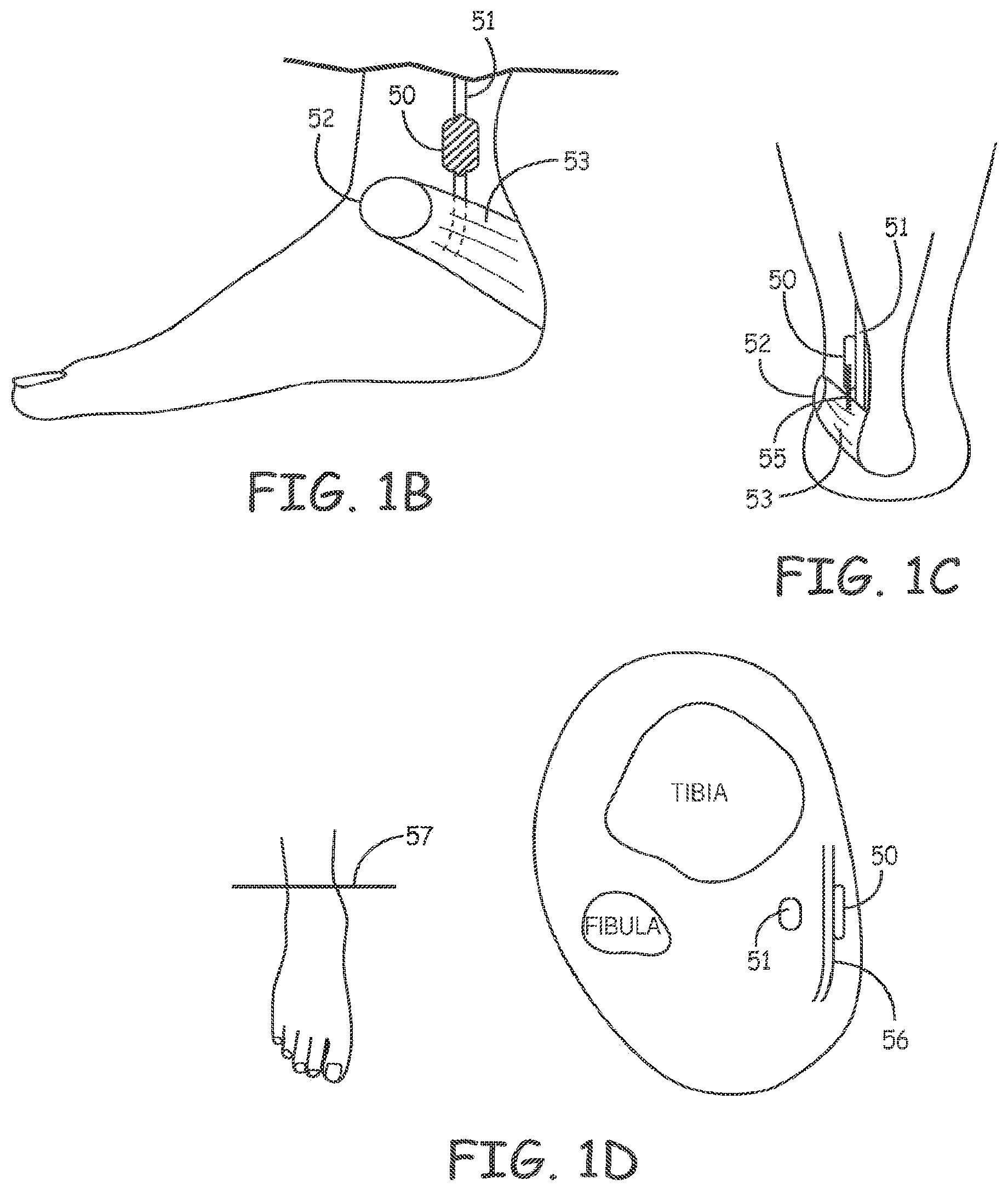Patent US11793998 Figure 2 – Minimally invasive implantable neurostimulation system