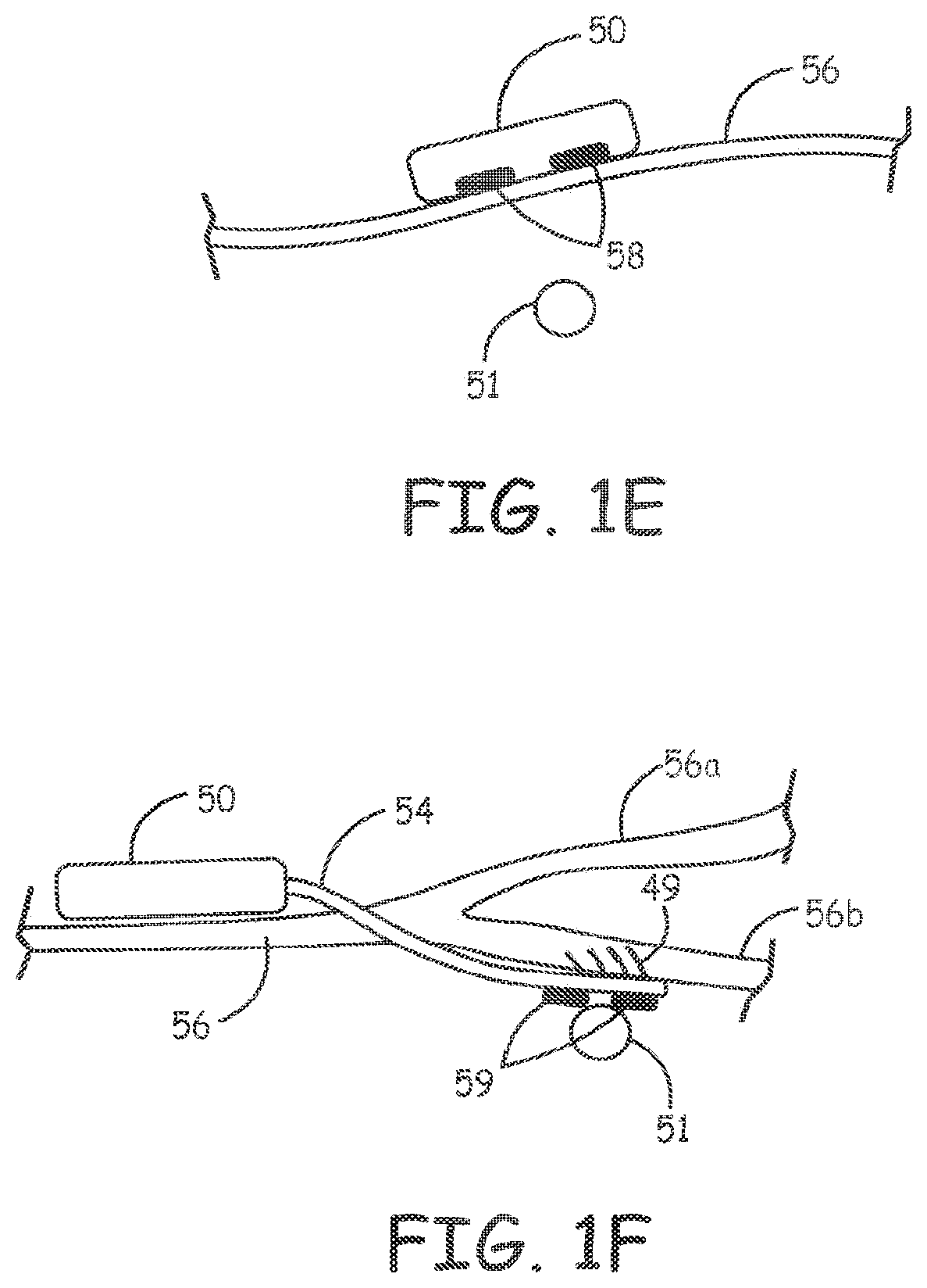Patent US11793998 Figure 3 – Minimally invasive implantable neurostimulation system