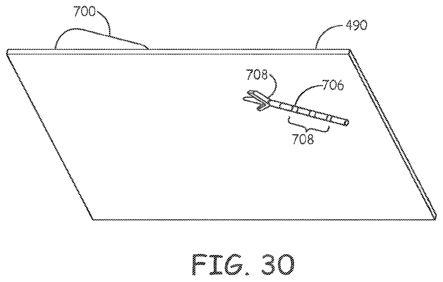 Patent US11793998 Figure 20 – Minimally invasive implantable neurostimulation system