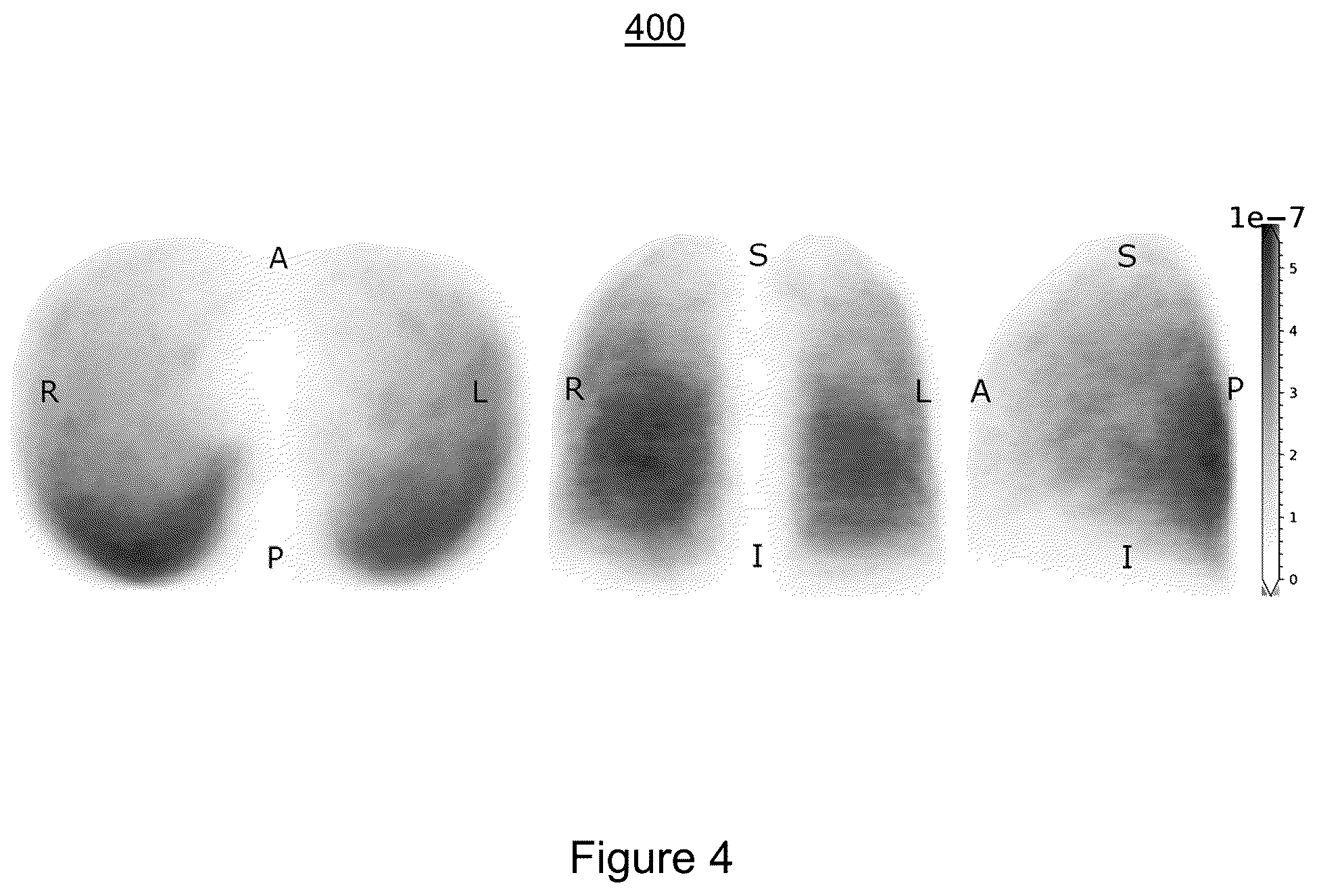 Patent US11810291 Figure 4 – Medical image synthesis of abnormality patterns associated with COVID-19